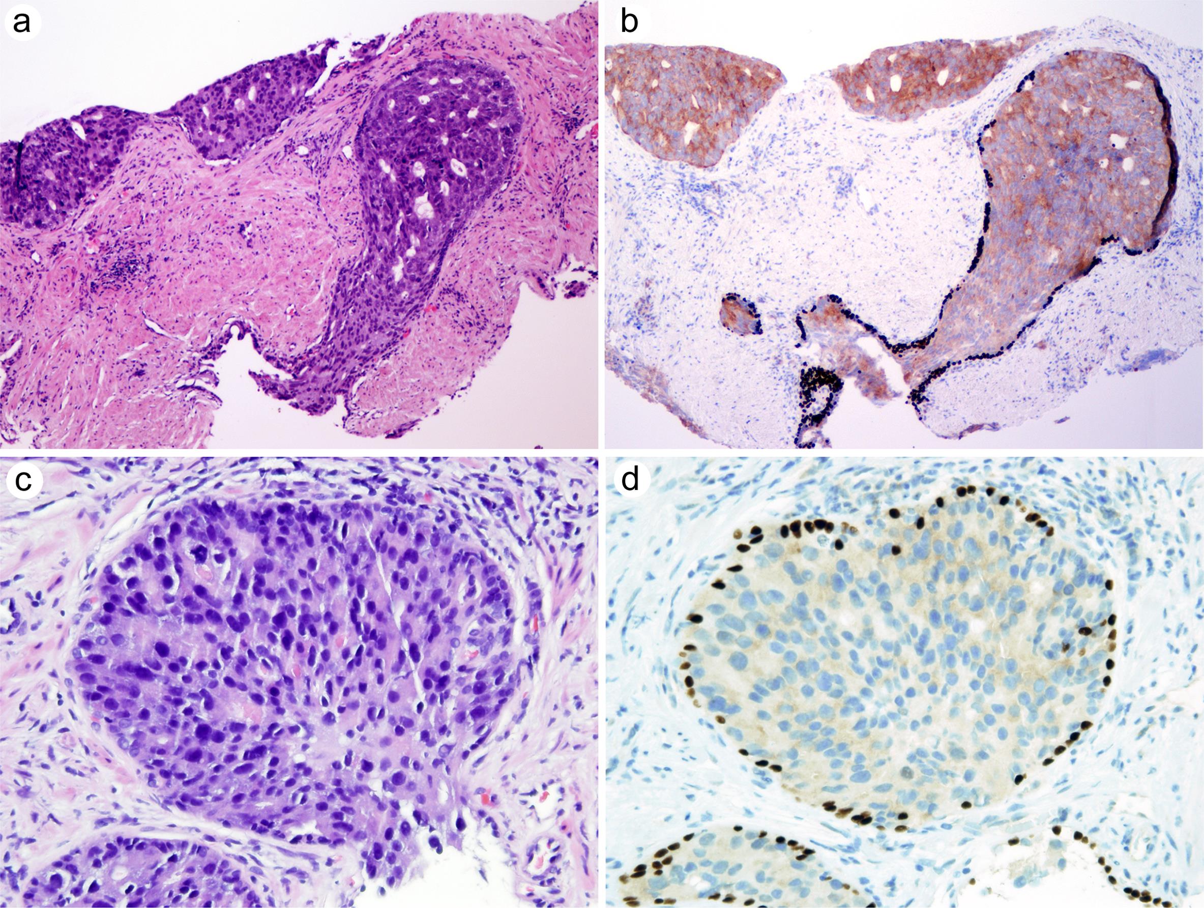 Intraductal carcinoma (IDC) shows atypical dense cribriform glands (a) (×100), which are positive for racemase and basal cell markers (CK903 and p63) (b) (×100). IDC exhibits a solid growth pattern (c) (×200) and is positive for racemase and p63 (d) (×200).