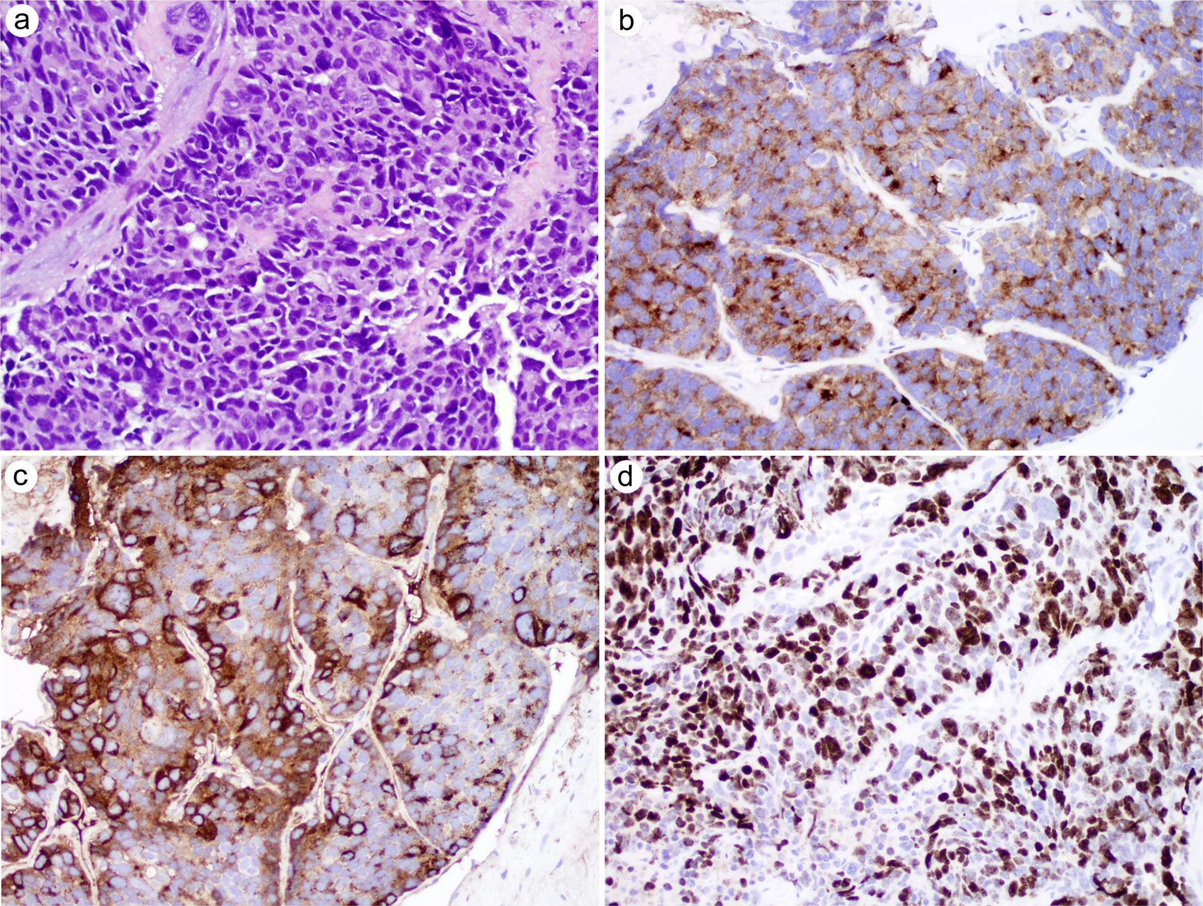 Treatment-related neuroendocrine prostatic carcinoma.