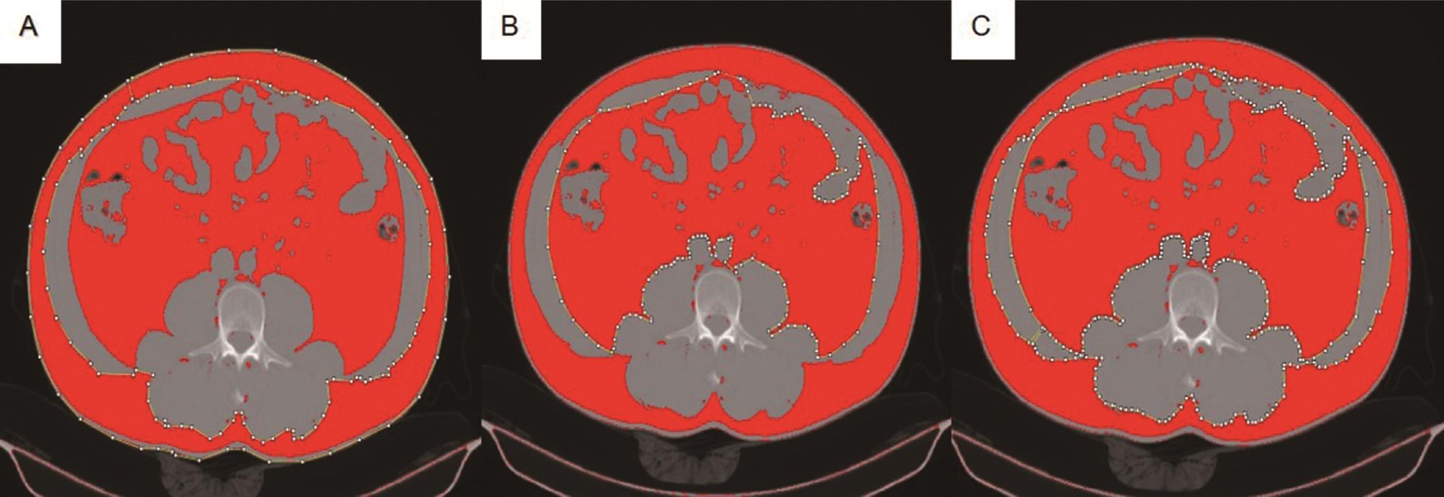 Illustrations of abdominal fat marked with ImageJ software. SAT (A), VAT (B), and IMAT (C).
