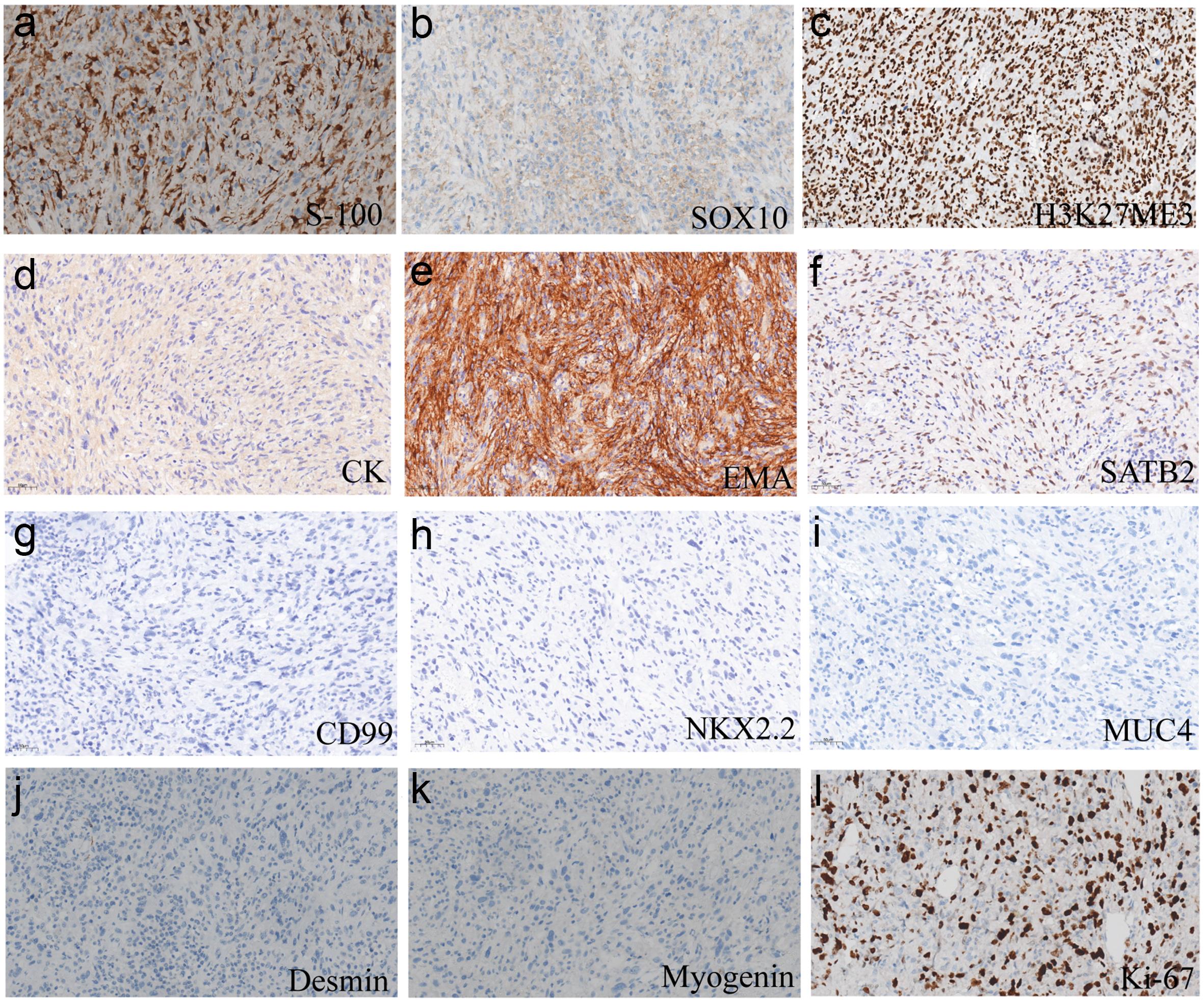 Immunohistochemical staining of the tumor.