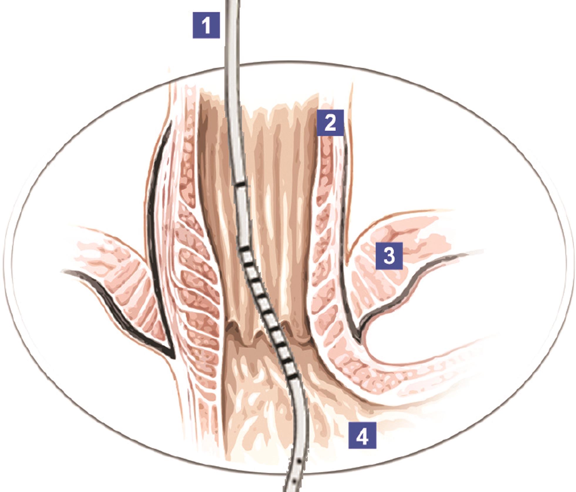 Edi catheter in relation to diaphragm. 