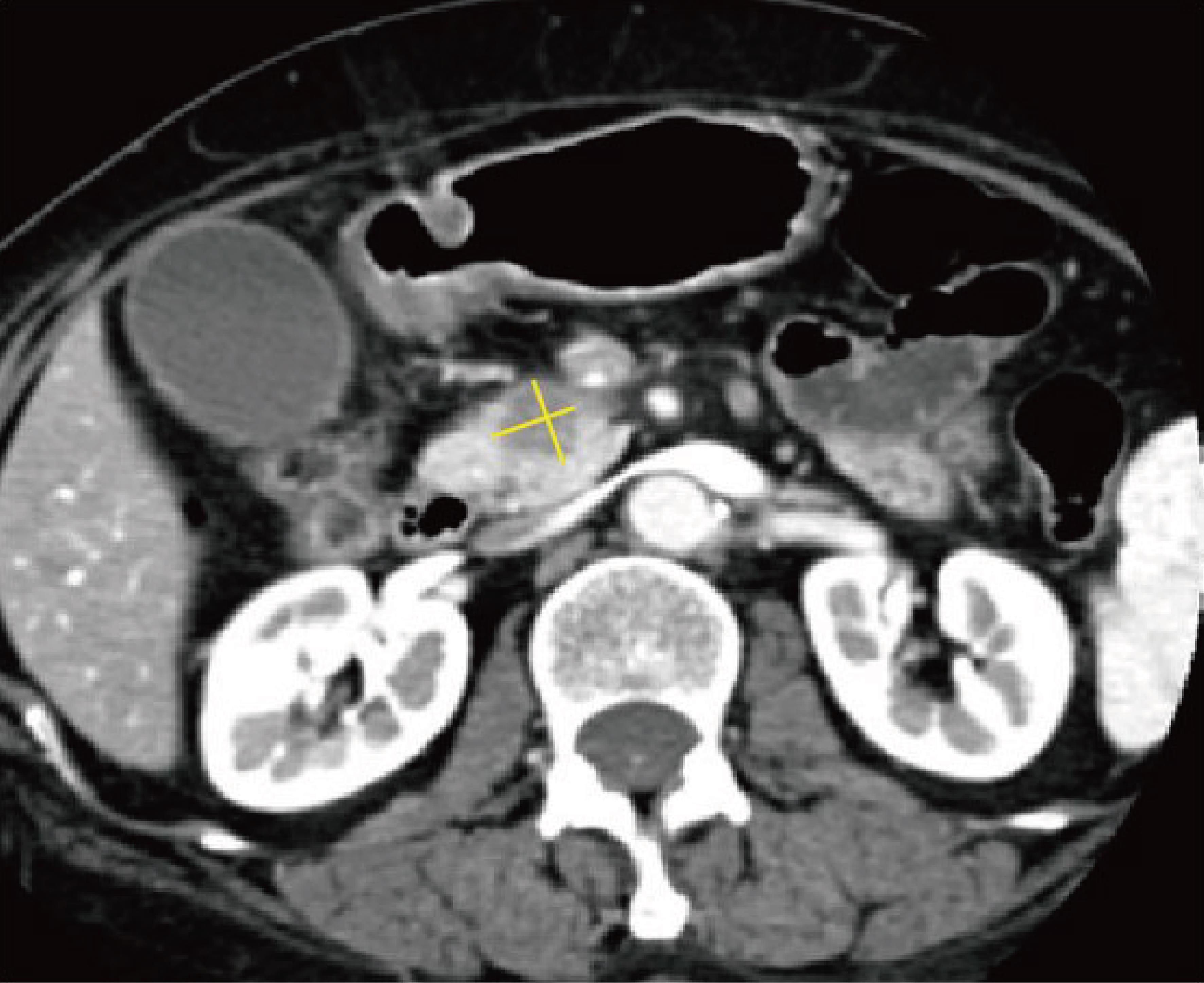 Measurement of pancreatic solid tumor size.