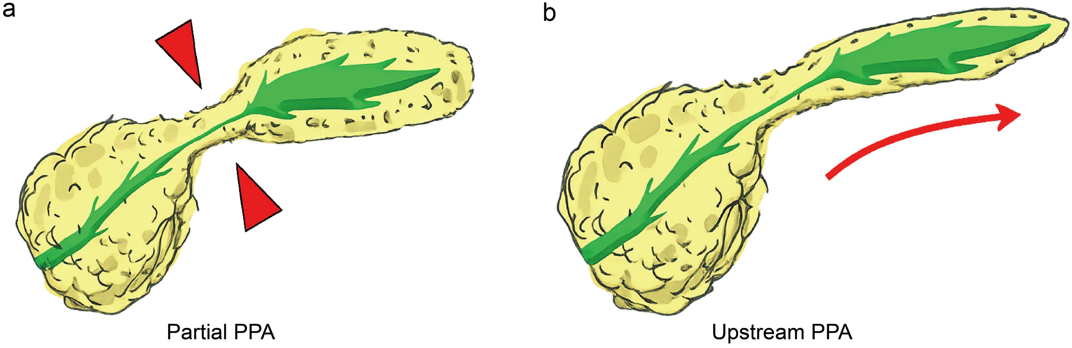 Schematic illustration of pancreatic parenchymal atrophy (PPA).