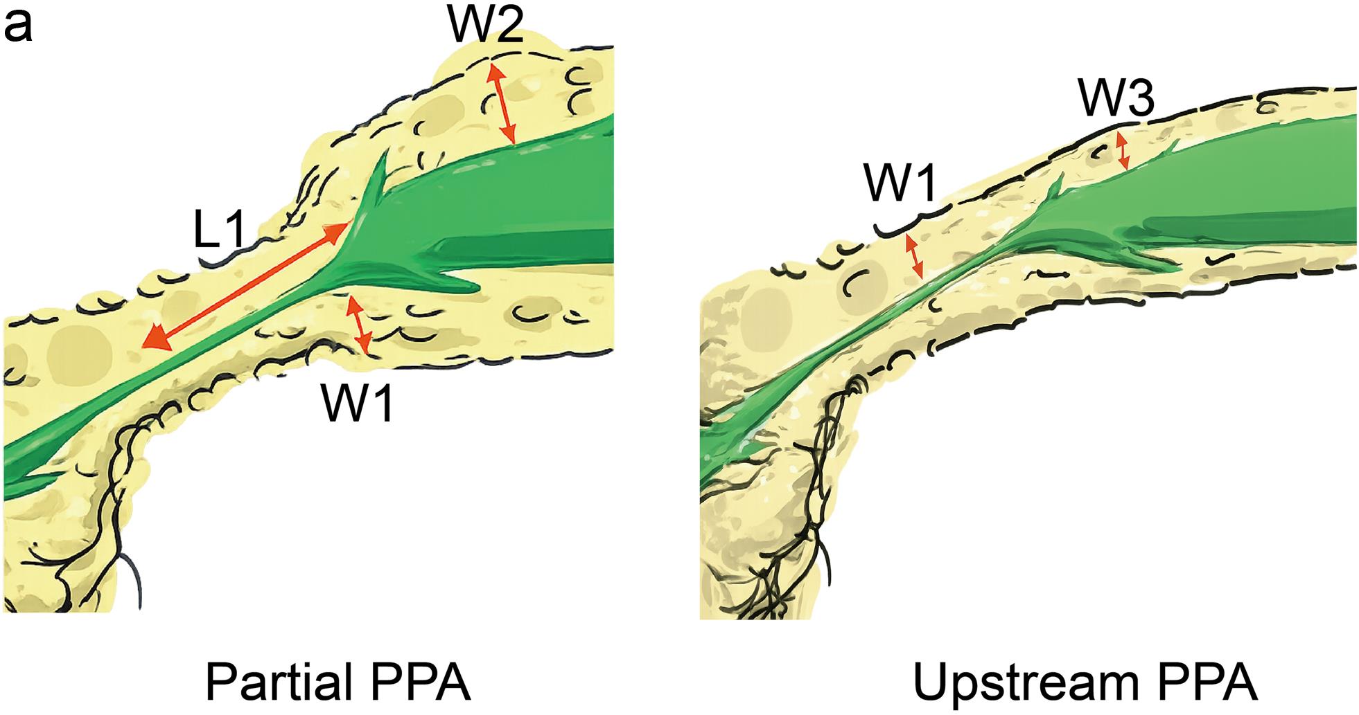 Criteria for evaluating pancreatic parenchymal atrophy (PPA).
