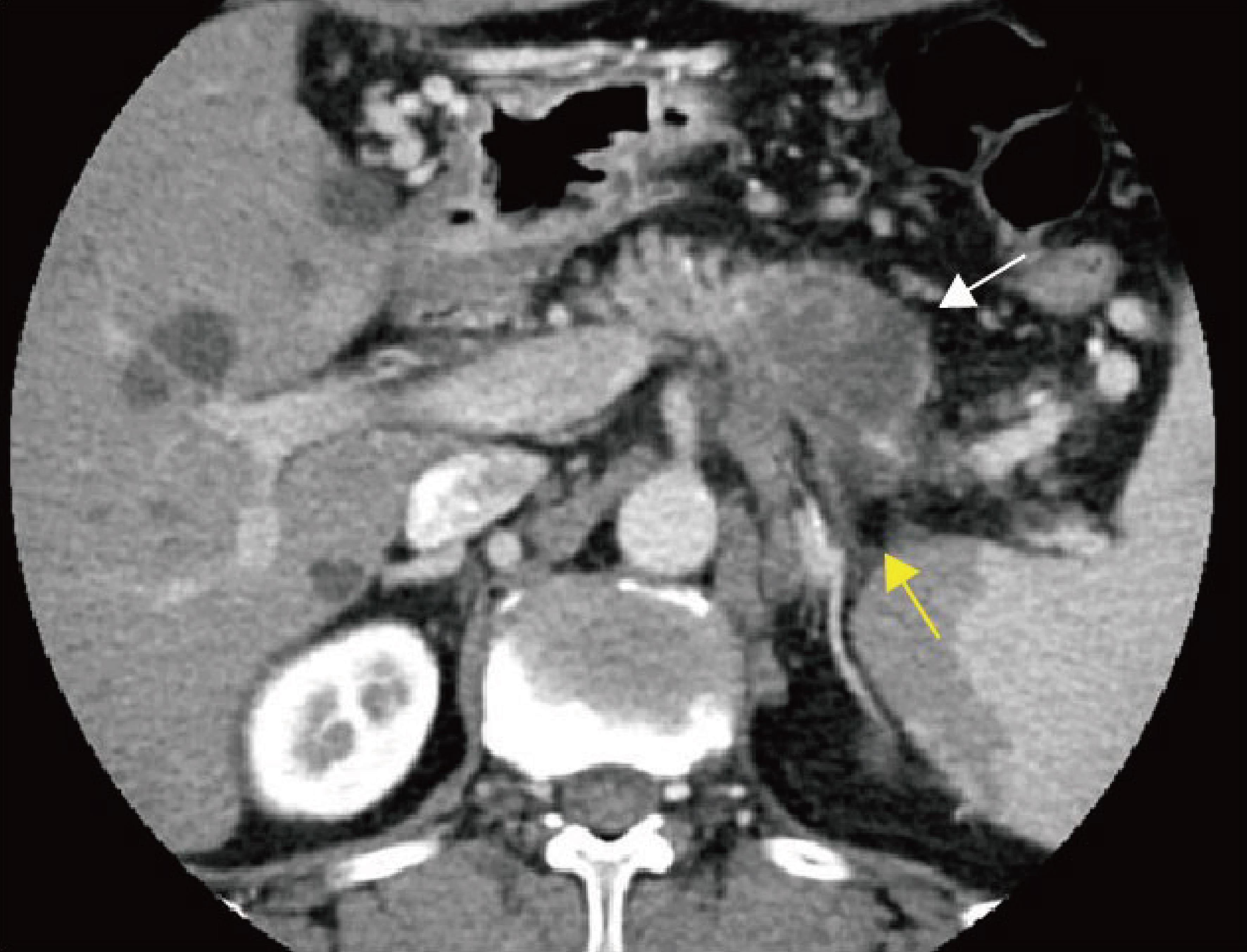 Pancreatic cancer with surrounding obstructive inflammation.