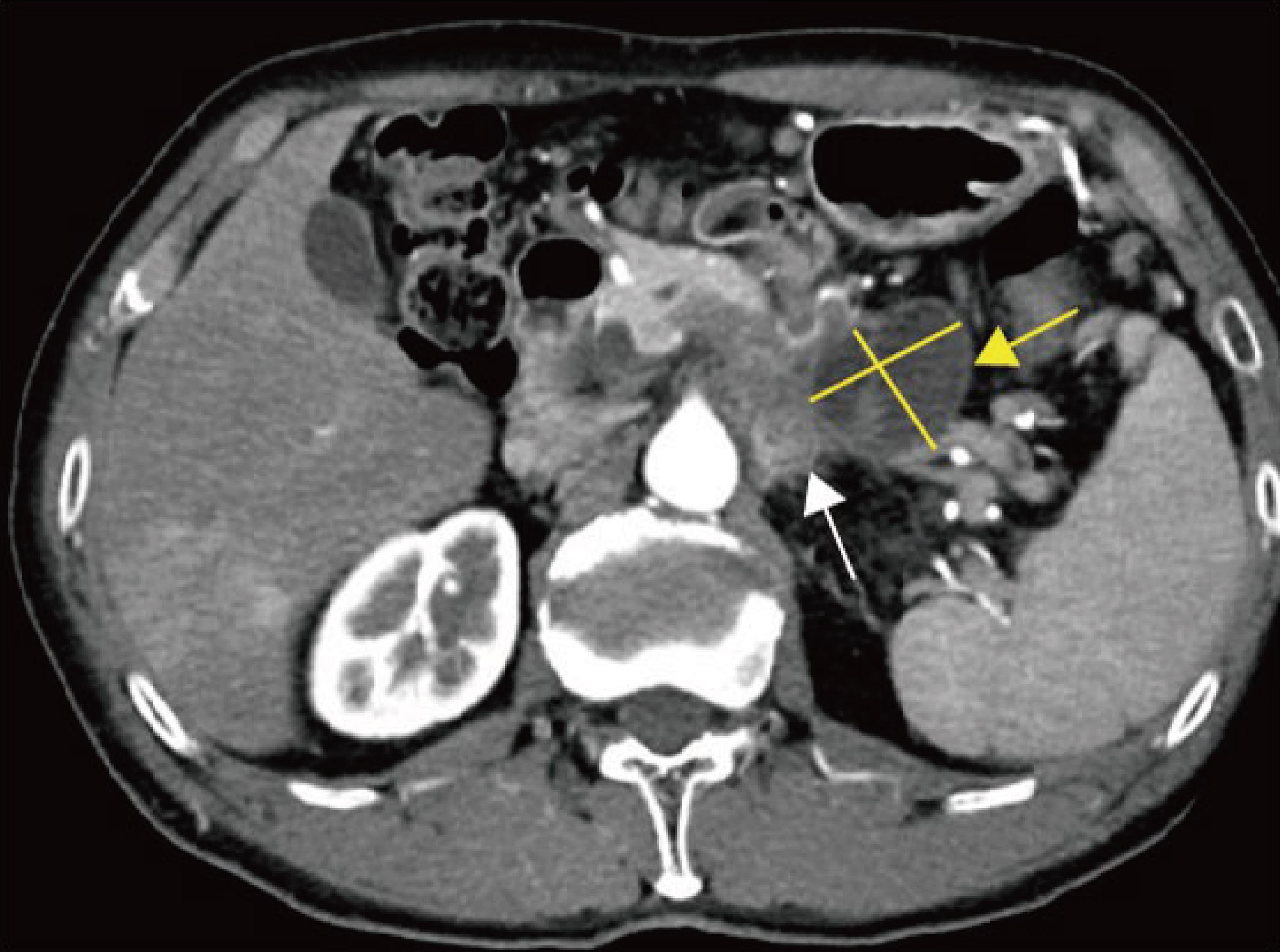 Pseudocyst formation secondary to pancreatic cancer.