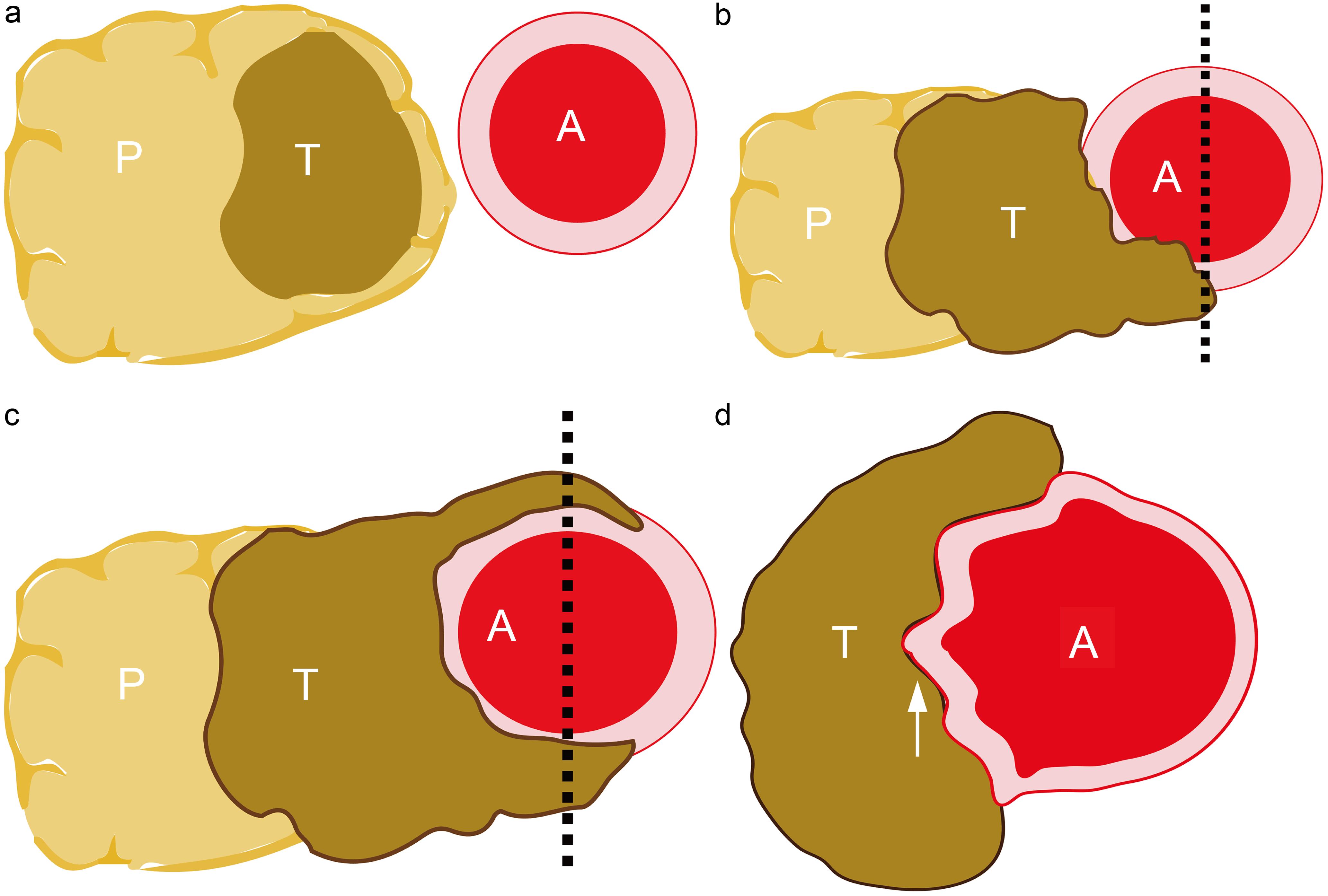 Schematic illustration of tumor–artery interface.