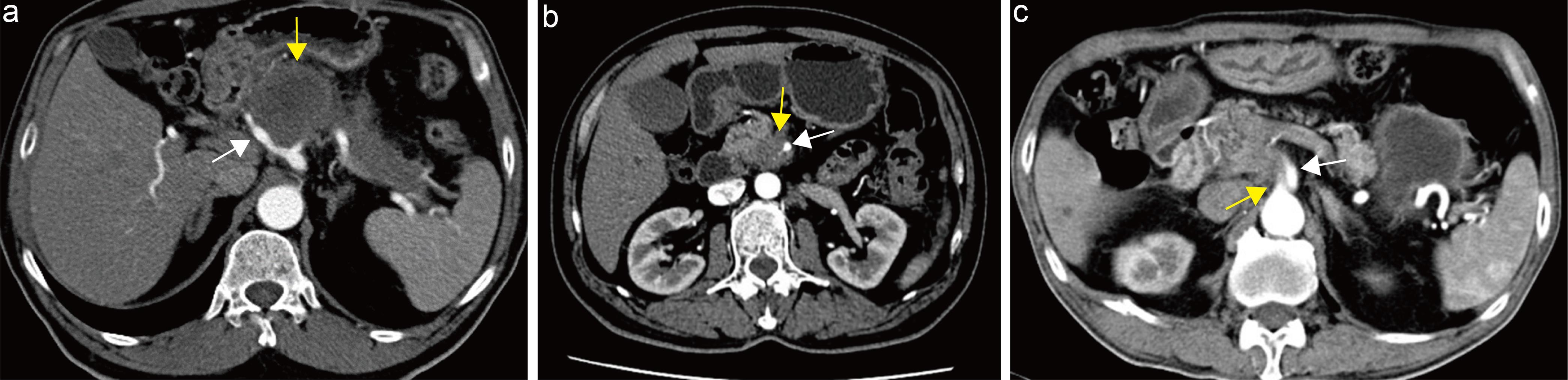 Evaluation of tumor–artery contact.