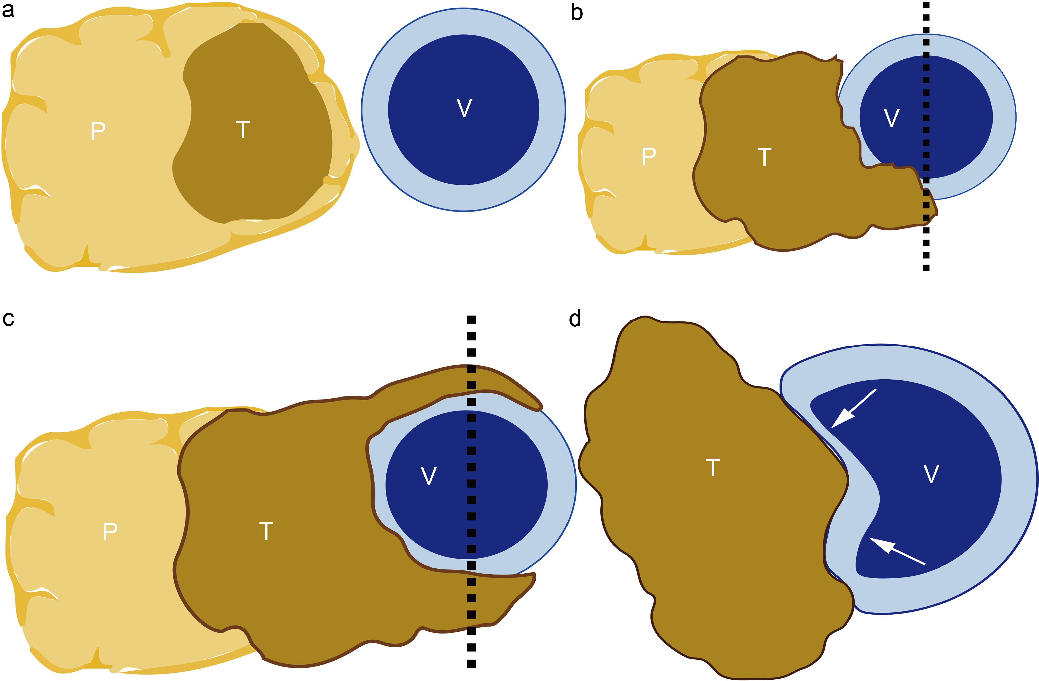 Schematic illustration of tumor–vein interface.