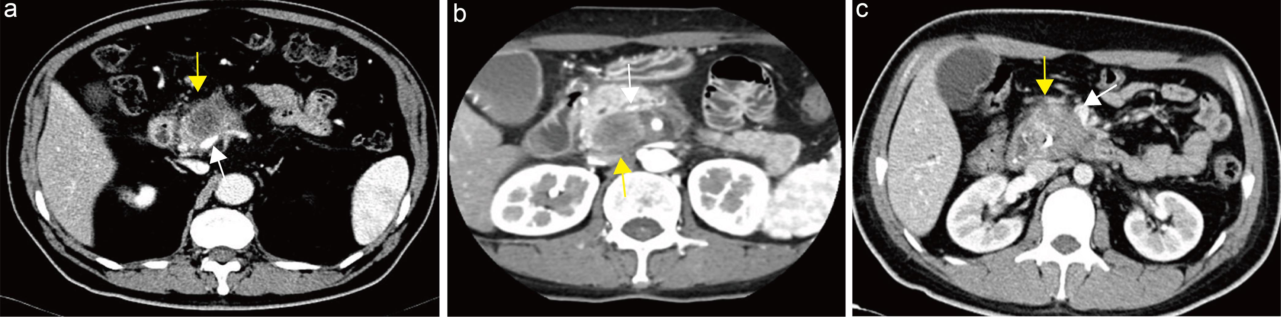 Evaluation of tumor–vein contact.