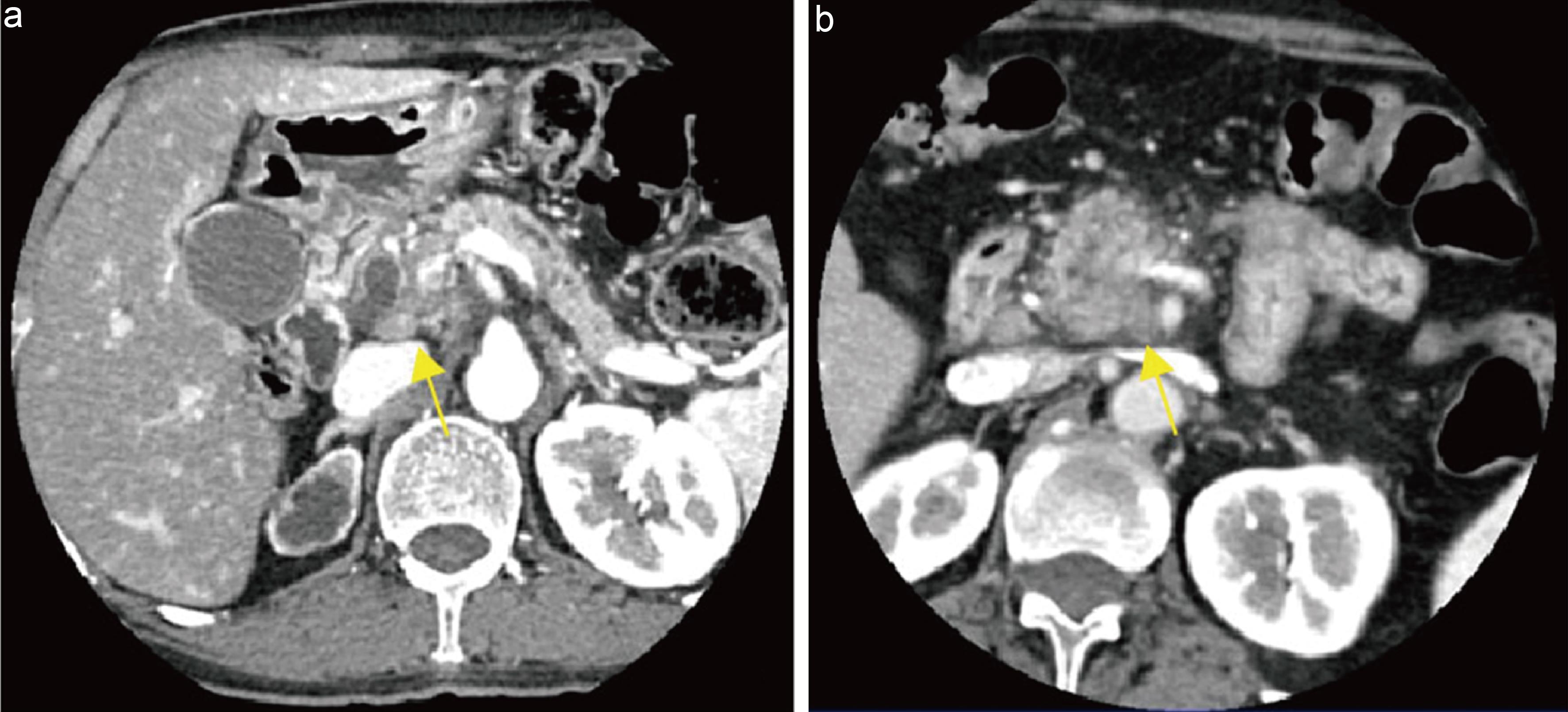Imaging evaluation of lymph nodes in pancreatic cancer.