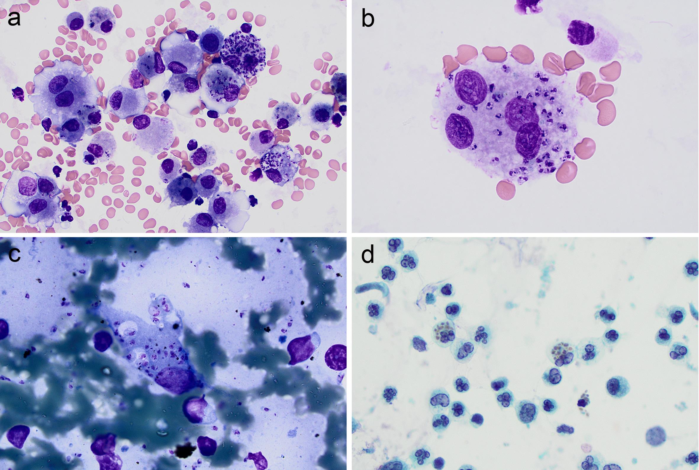 Numerous intra/extracellular Leishmania amastigotes in bronchoalveolar lavage (BAL) and lymph node fine needle aspiration (FNA) specimens (BAL, Giemsa-Wright stain, a: 500×, b: 1,000×; lymph node FNA, c: 1,000×), and intra/extracellular spores of histoplasmosis in BAL from a different teaching case (Papanicolaou stain, d: 400×).