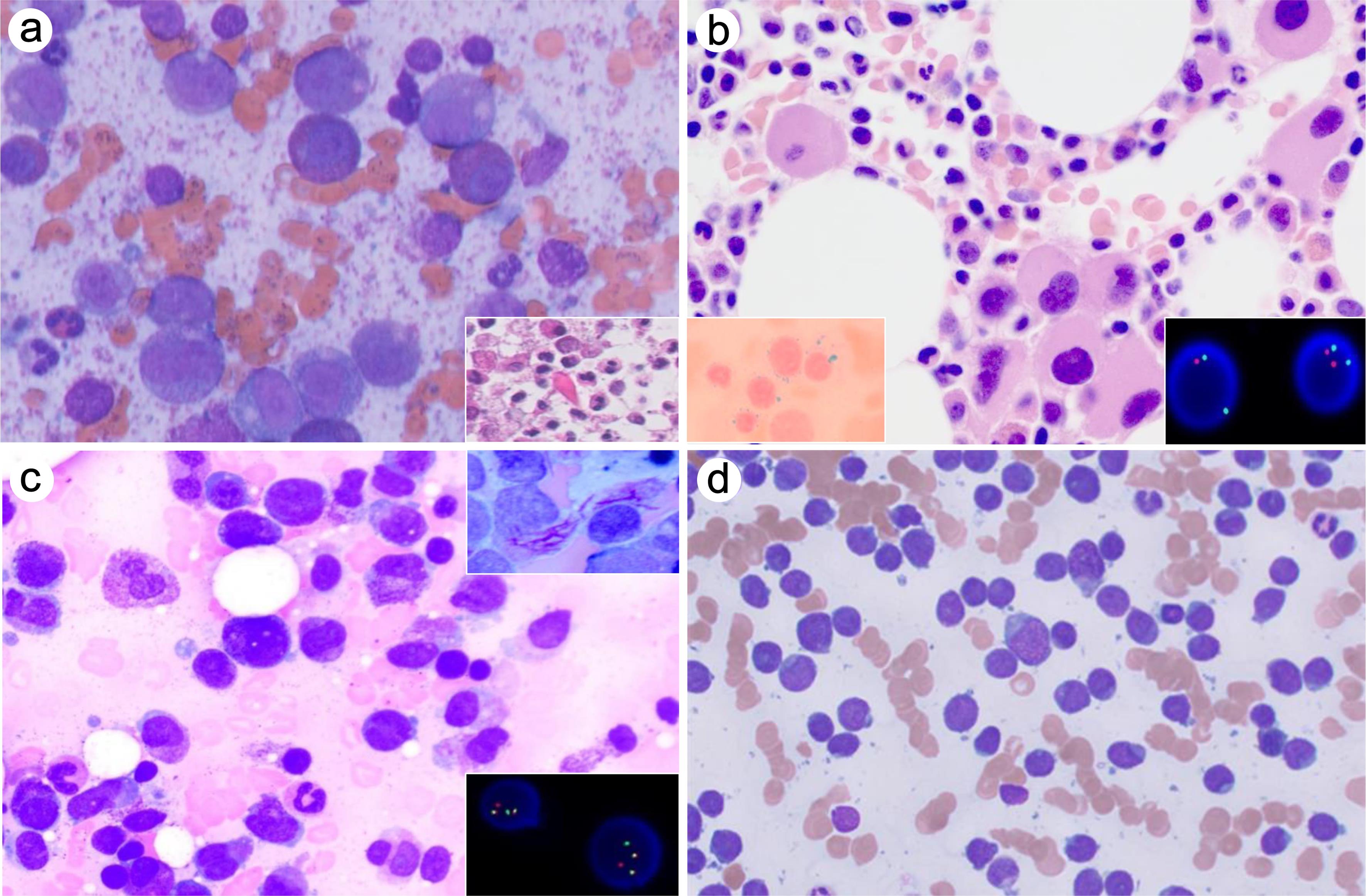 Myeloid neoplasms.