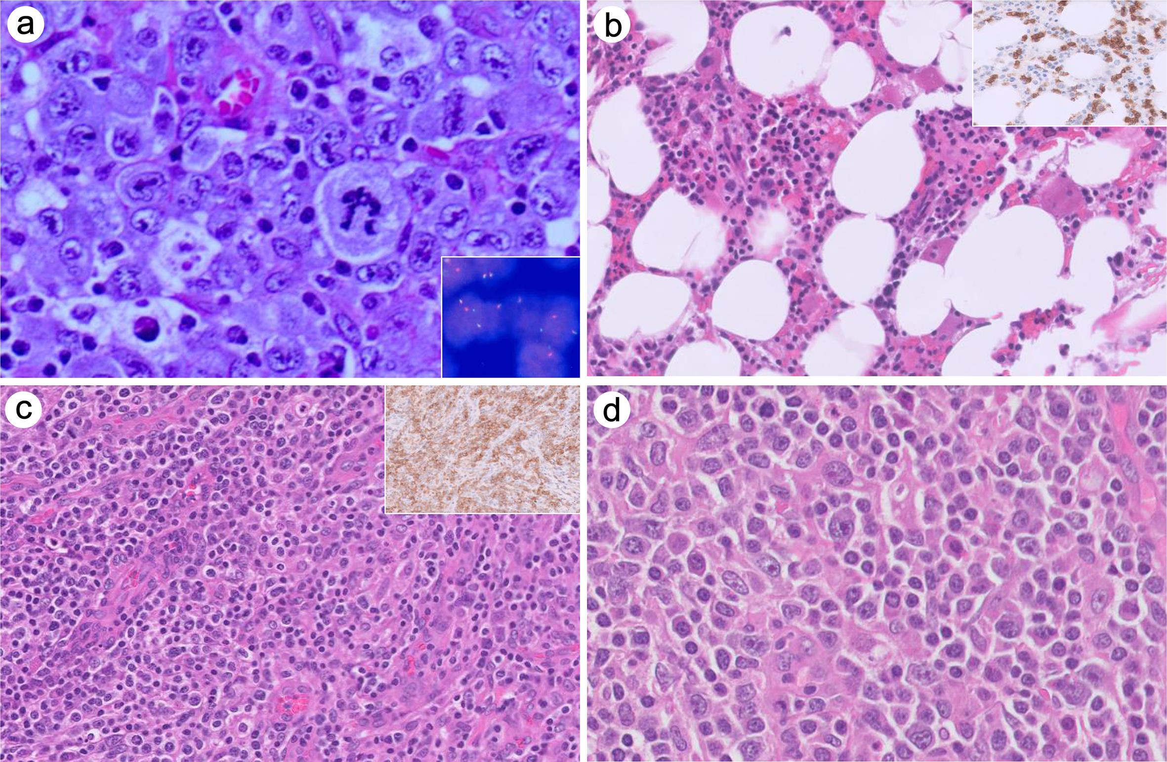 T-cell lymphomas.