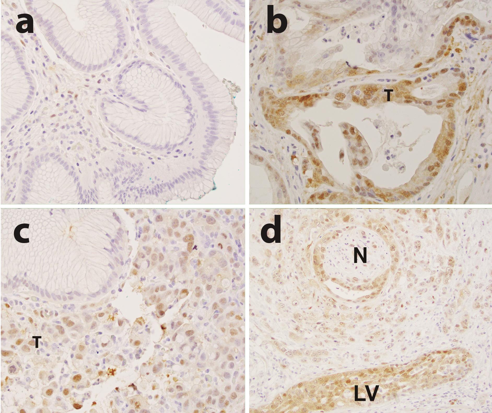 YAP1 immuno-reactivity in a case of esophageal adenocarcinoma.