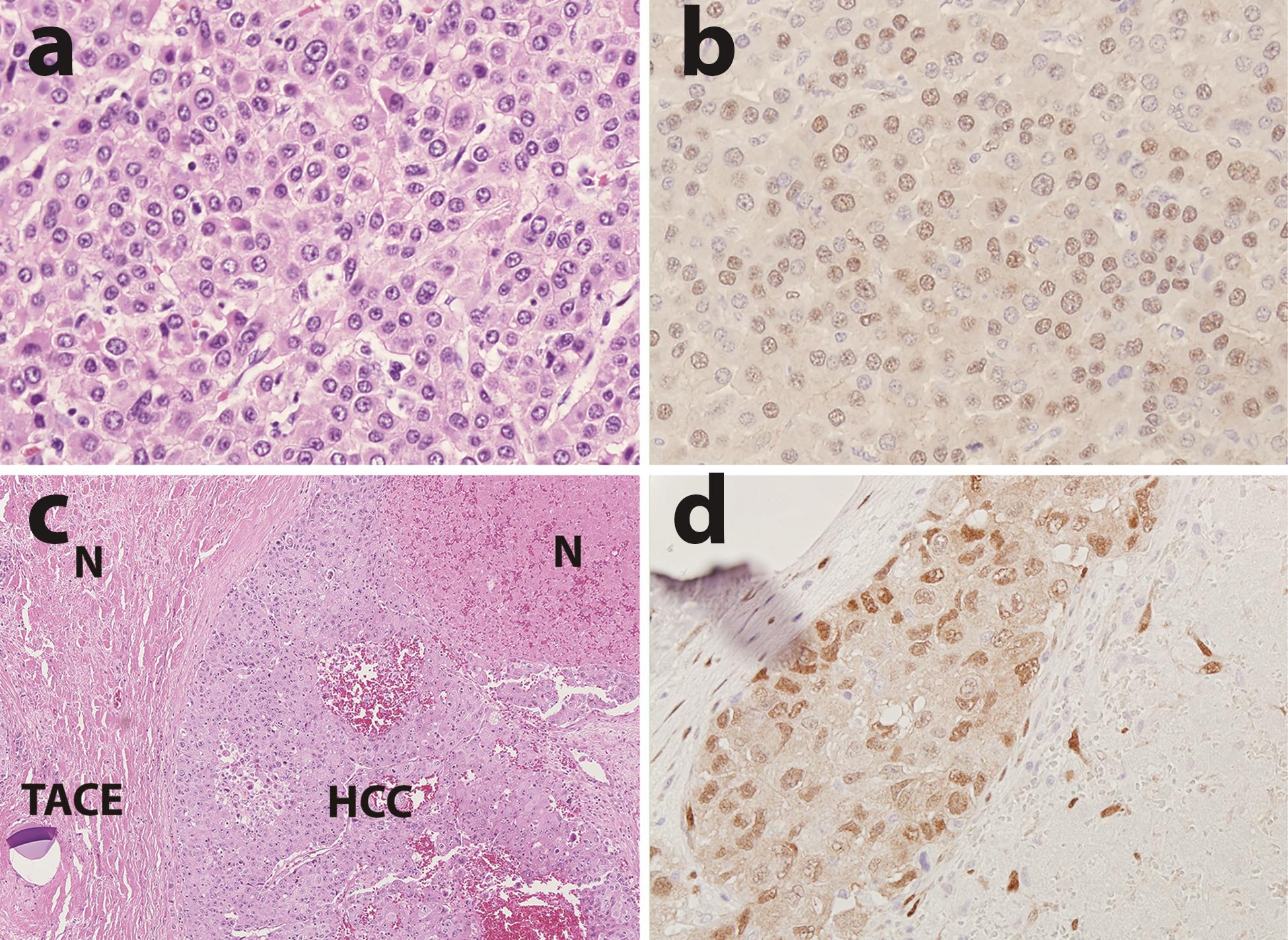 YAP1 immuno-reactivity in a case of primary hepatocellular carcinoma (HCC) (a, b) and the residual HCC after trans-arterial chemoembolization (TACE) treatment (c, d) with background of TACE-caused tumor necrosis (N) (a and c, H&E stain; a, 400×; c, 100×;) YAP1 is weakly positive in the primary HCC (b) but increased expression in the residual HCC (d) (b–d, YAP IHC, 400×).
