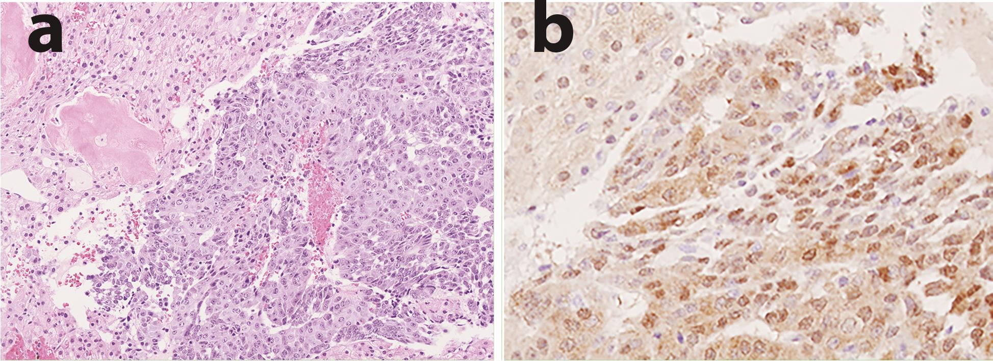 YAP1 immuno-reactivity in a case of hepatoblastoma (HB).