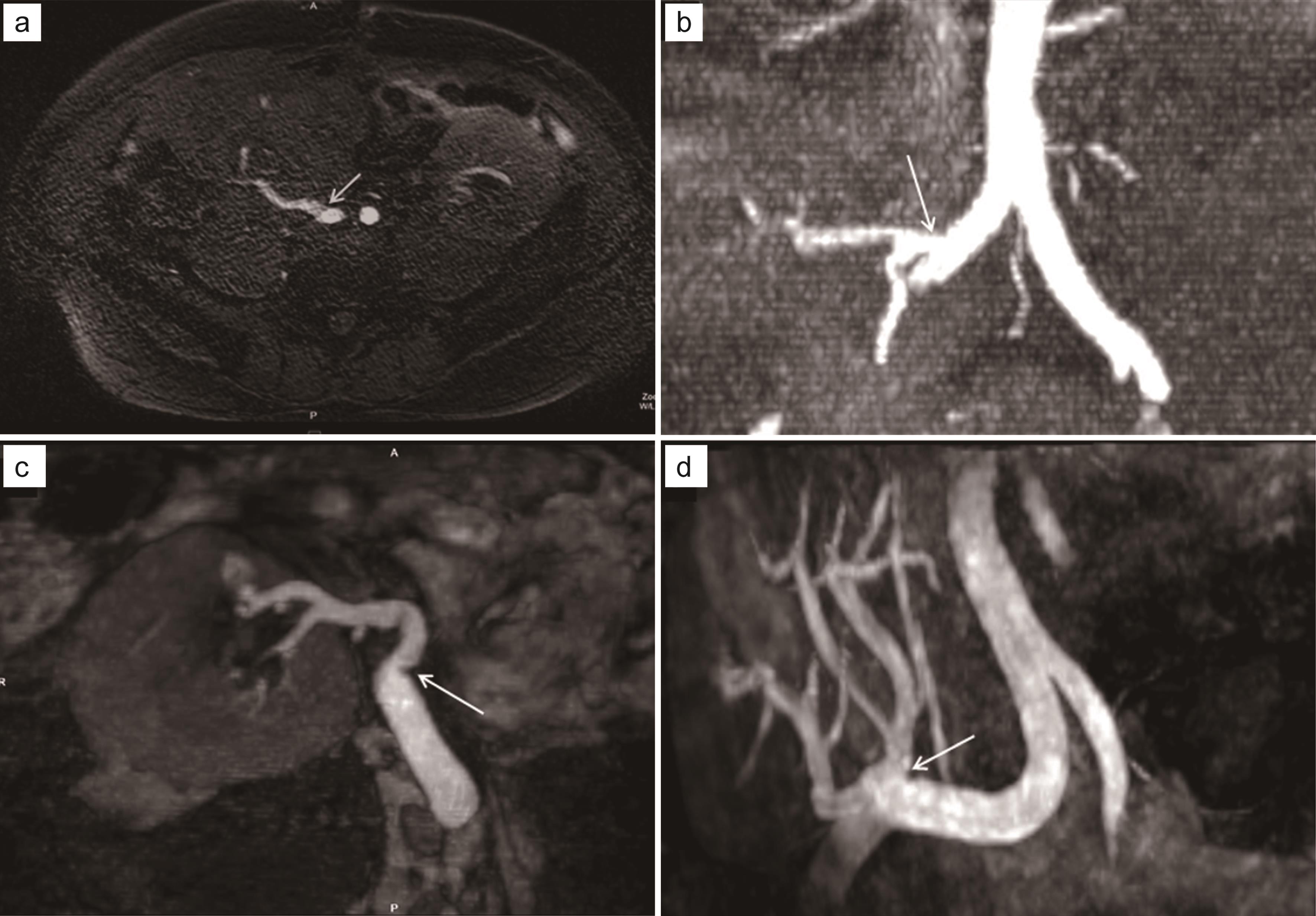 Normal QISS MRA and reformat in a 48-year-old male with a 1-year history of right lower quadrant kidney transplant that presented with mild renal dysfunction (GFR = 48) and abnormal Doppler ultrasound (a and b); Normal appearance of a 3D SSFP MRA reformat in a 60-year-old female with a 3-year history of right lower quadrant kidney transplant presented with renal dysfunction (GFR = 32) and abnormal Doppler ultrasound (c and d).