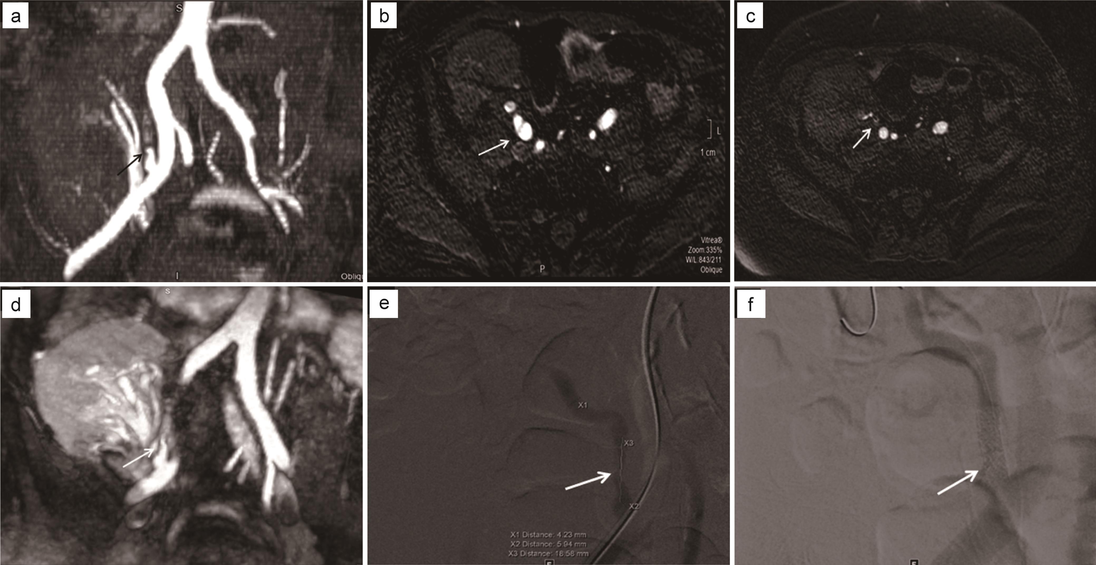 59-year-old male with right lower quadrant renal transplant presented 2 months after transplantation for evaluation high velocity at the artery anastomosis and renal dysfunction (GFR = 5).