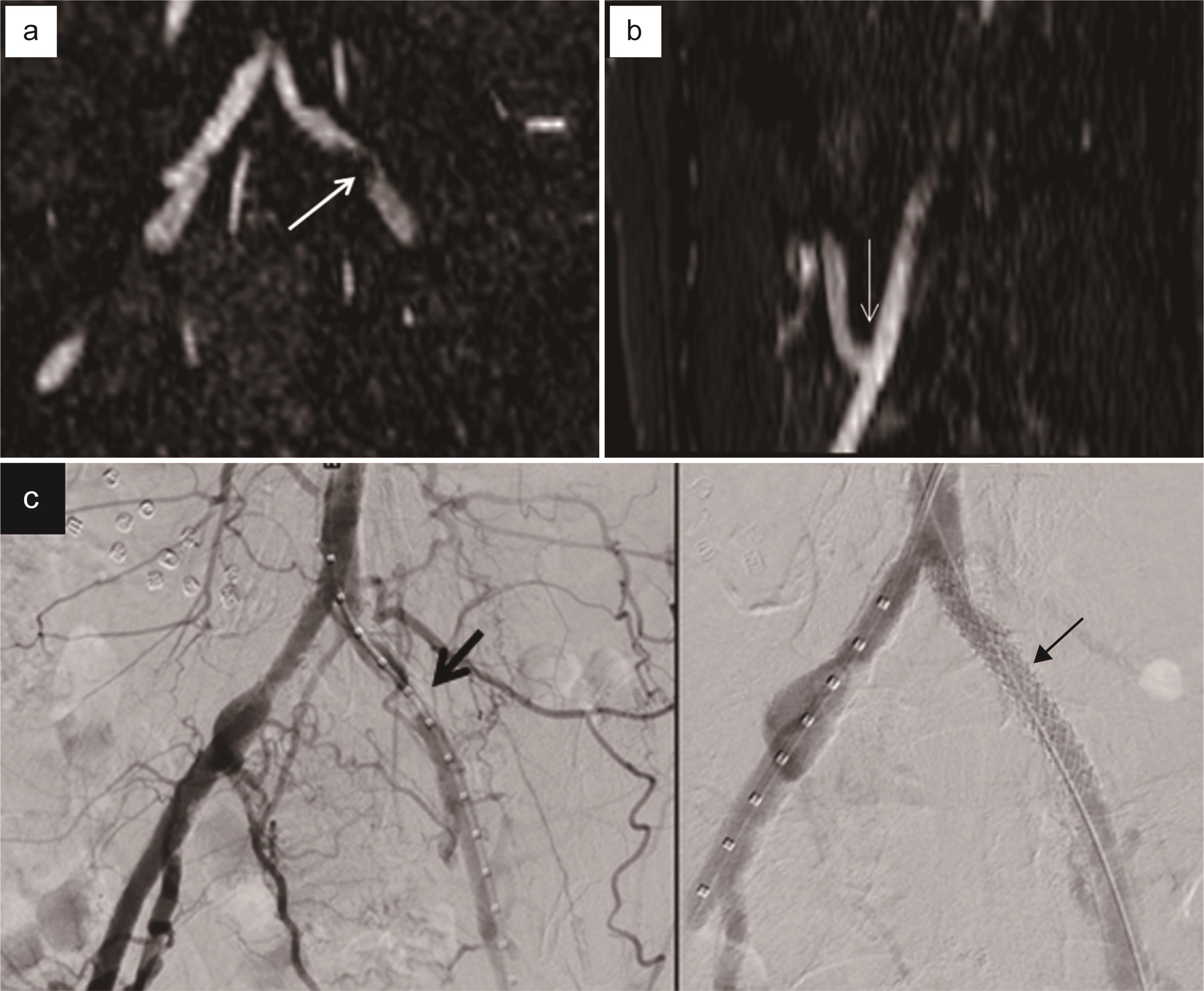 55-year-old female with left lower quadrant renal transplant in 2003 presented with transplant dysfunction (GFR = 26).