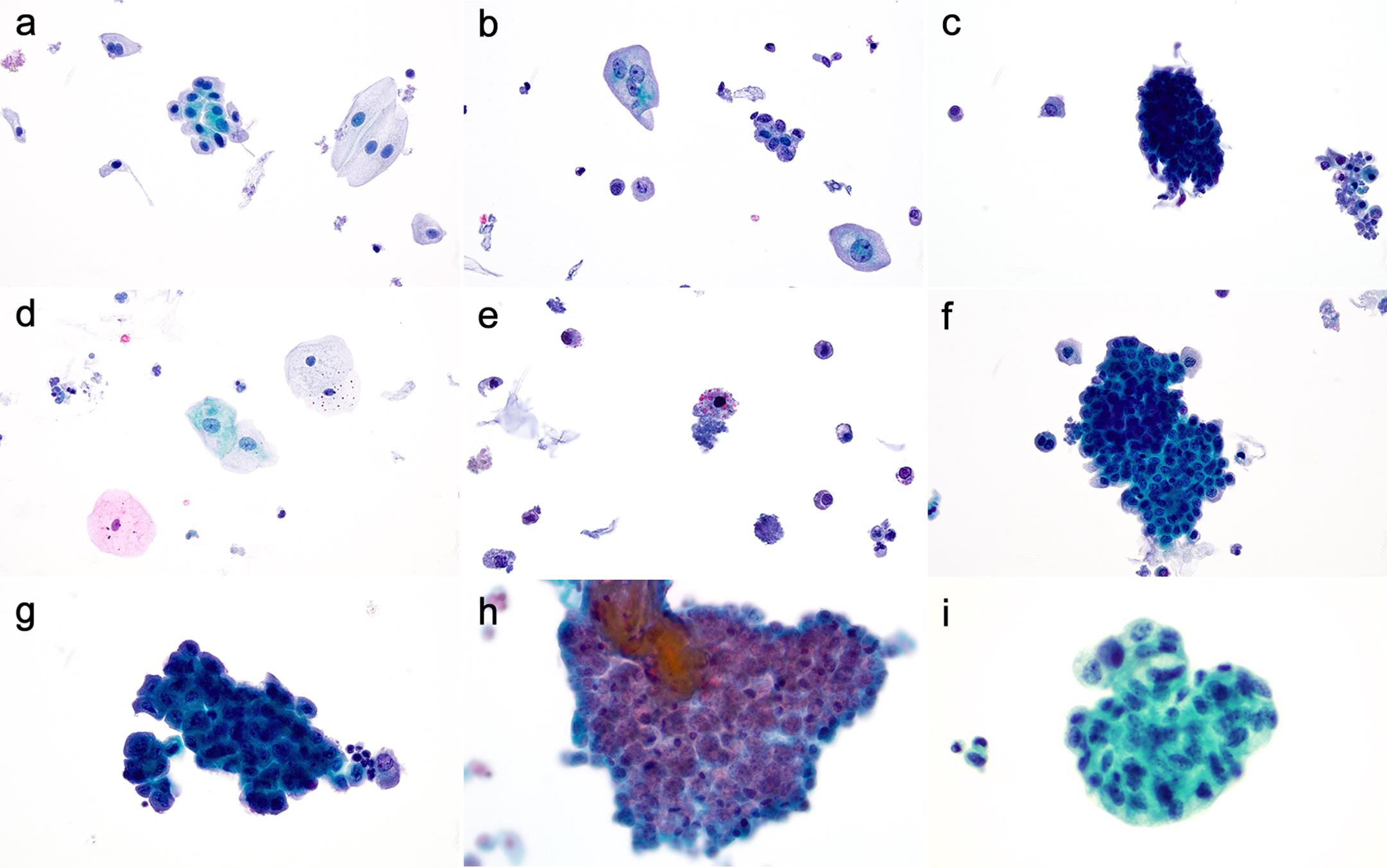 Negative for high-grade urothelial carcinoma (NHGUC).