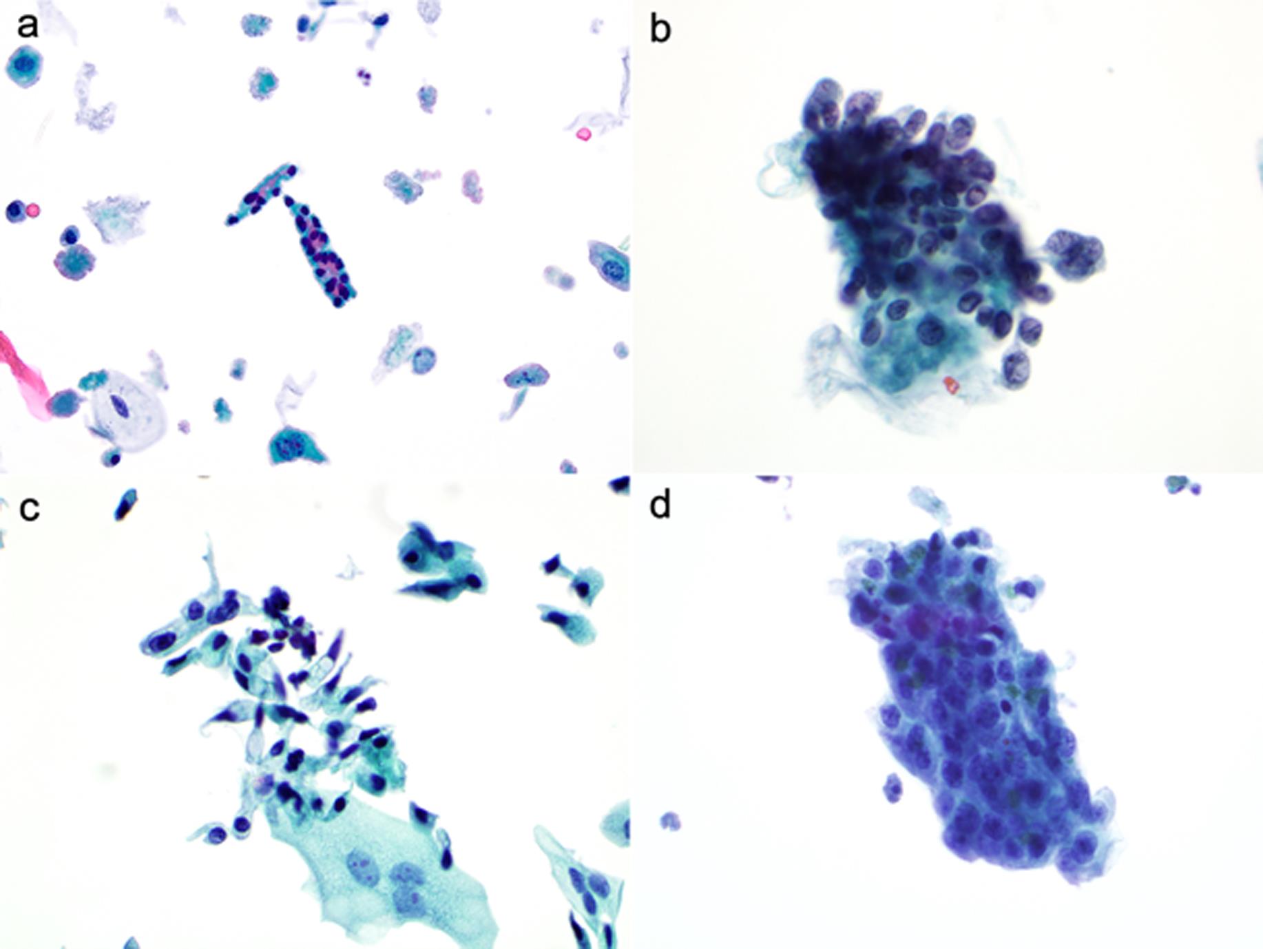 NHGUC: benign glandular cells. Renal tubule cells, present in renal tubule casts (a). Endometriosis, columnar glandular cells with wispy and vacuolated cytoplasm, and small round or oval nuclei (b) Cystitis glandularis, columnar cells with moderate vacuolated cytoplasm, and small round nuclei (c). Prostatic cells, columnar glandular cells arranged in glandular formation, with cytoplasmic pigments (d).