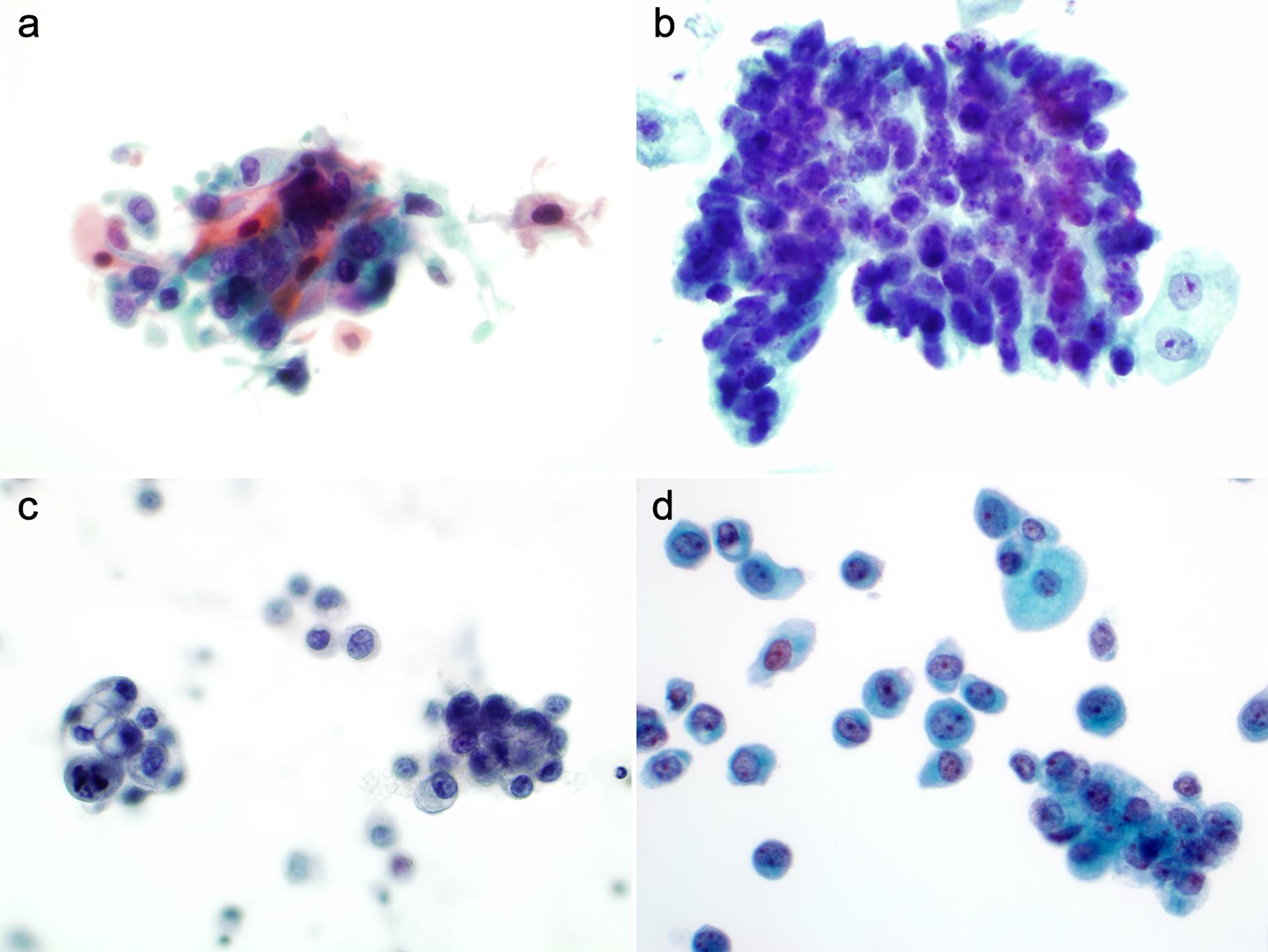 Variants of HGUC. HGUC may present with squamous differentiation (a), glandular differentiation (b), micropapillary HGUC features (c), and plasmacytoid HGUC features (d).