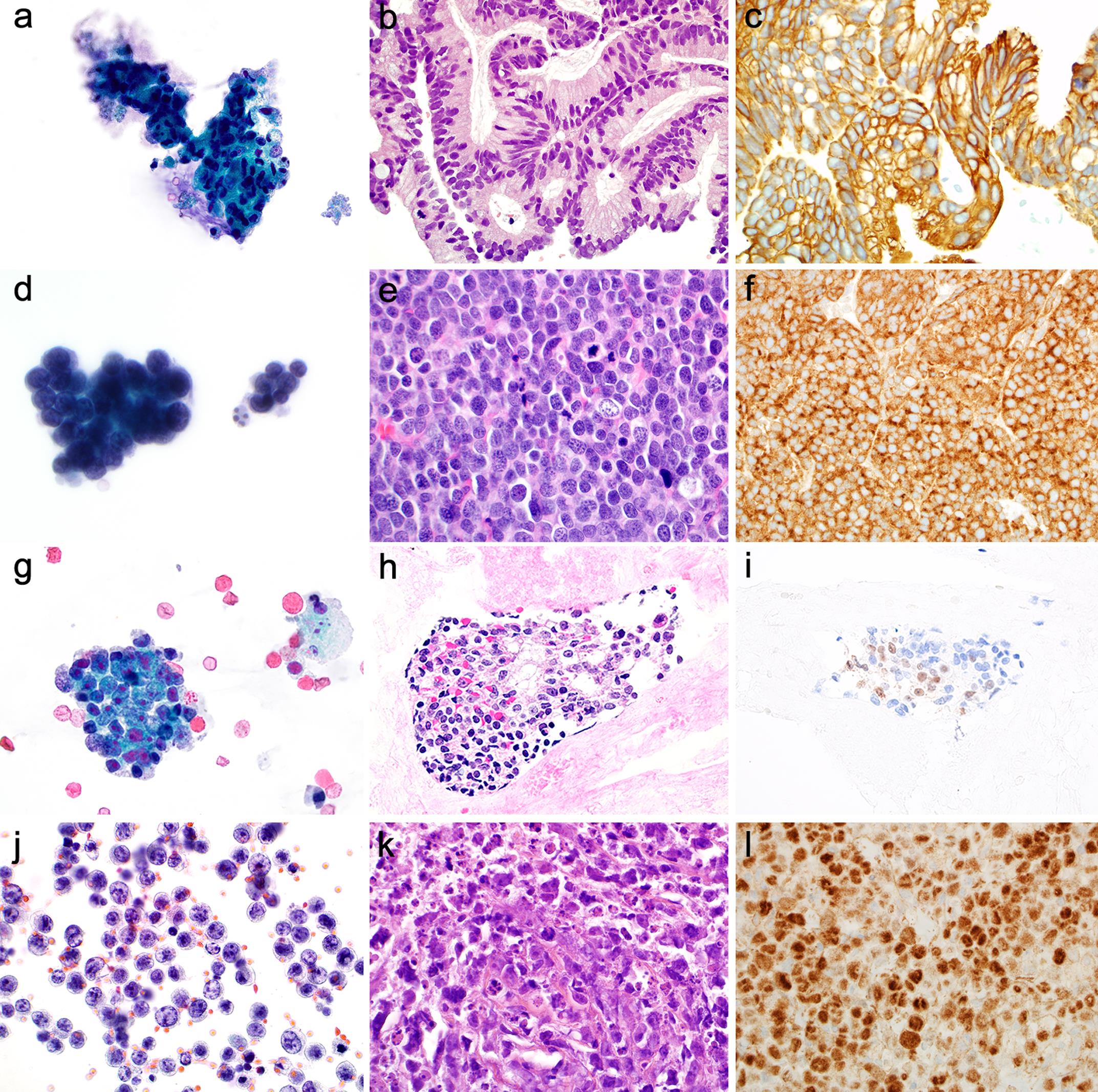 Other malignancies. Adenocarcinoma: Malignant columnar cells are arranged in glandular formation, with elongated hyperchromatic nuclei (a), and moderate vacuolated or delicate cytoplasm (b), and present with low N/C ratios. The follow-up surgical resection shows the adenocarcinoma, which is positive for CK7 and CK20 (c). Small cell carcinoma: the cohesive cluster of cells with hyperchromatic round/oval nuclei, nuclear molding, and scant cytoplasm (d and e). The tumor cells are positive for synaptophysin (f). Prostatic adenocarcinoma: the cohesive nest of epithelial cells with prominent nucleoli and granular cytoplasm (g, h); Tumor cells are positive for NKX3.1 (i). Diffuse large B-cell lymphoma (DLBL): Discohesive cells with coarse chromatin, prominent nucleoli, irregular nuclear membrane, and minimal cytoplasm (j and k). Tumor cells are positive for PAX-5 (l).