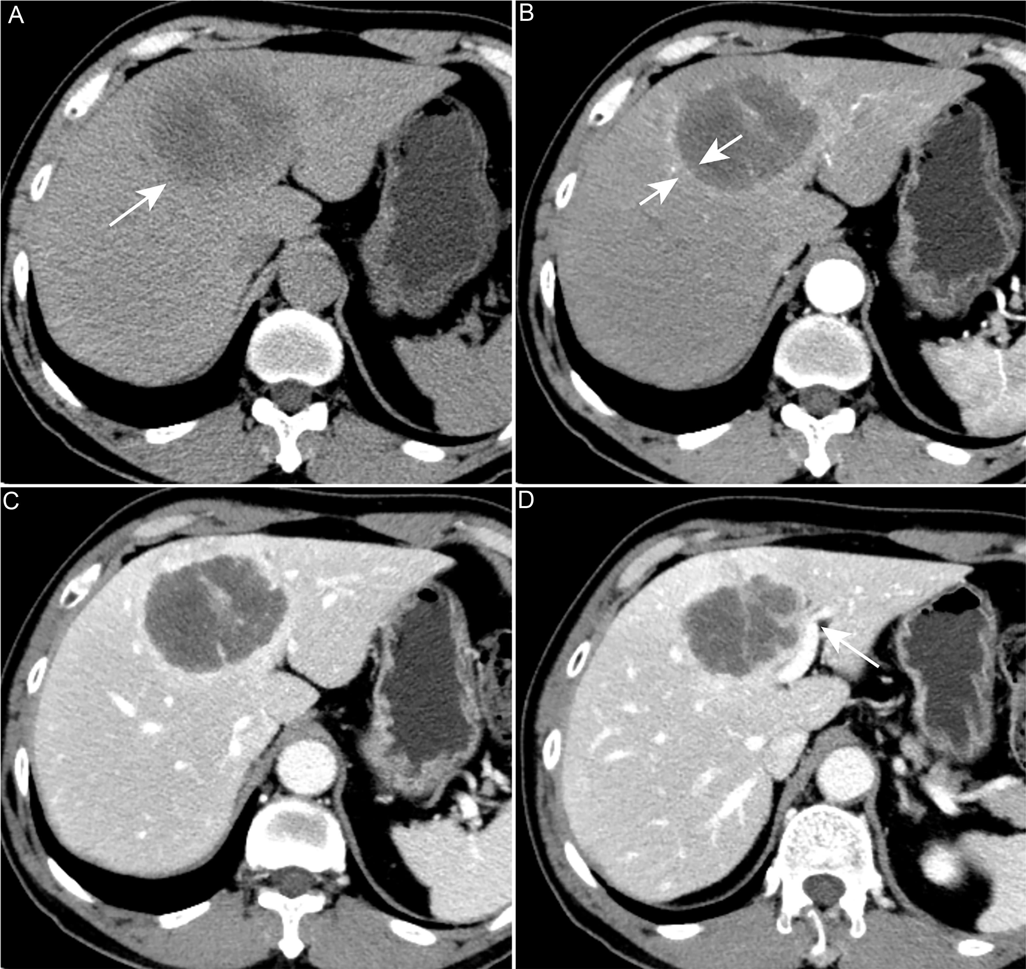 A 68-year-old male patient pathologically confirmed with mass-forming SD-iCCA in the left lobe of the liver.