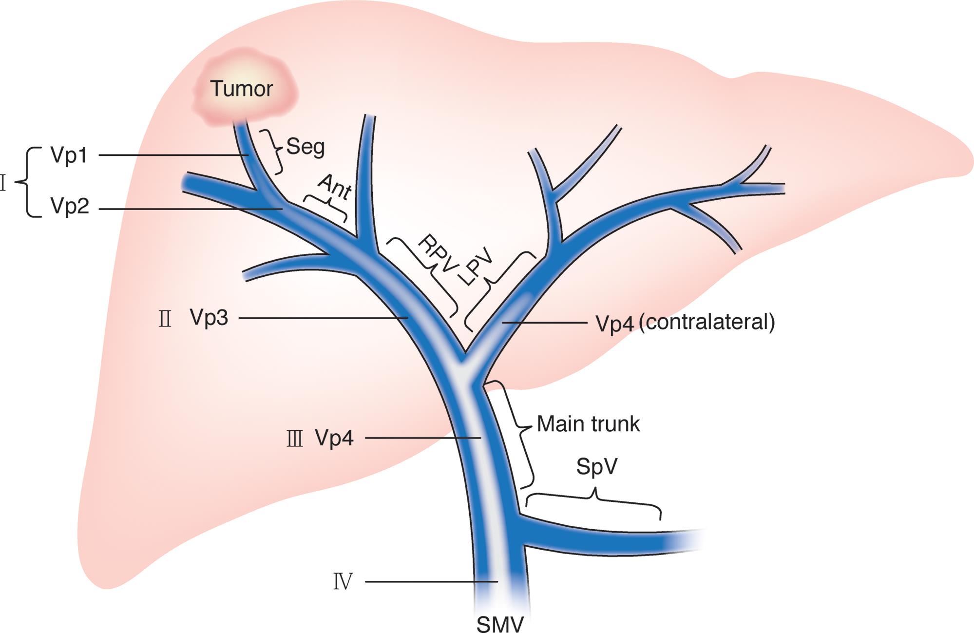 Classification of hepatocellular carcinoma with portal vein tumor thrombus.