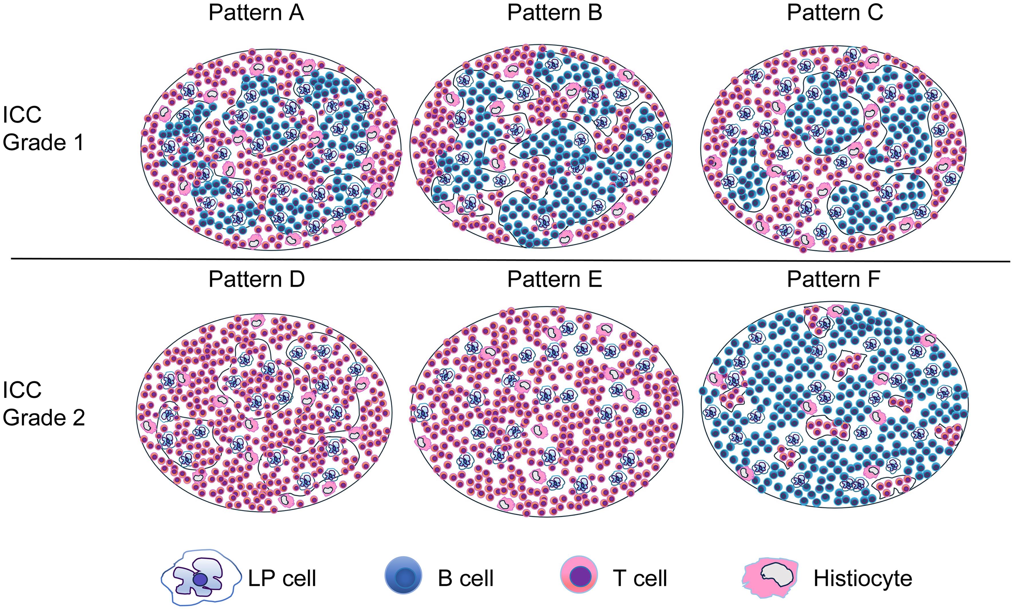 Schematic diagram of histopathologic patterns in NLP and relevant ICC grades.