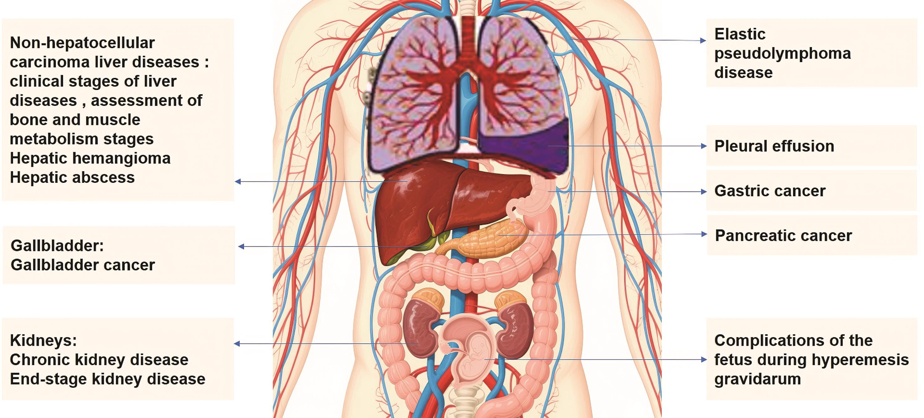 PIVKA-II in non-HCC diseases.