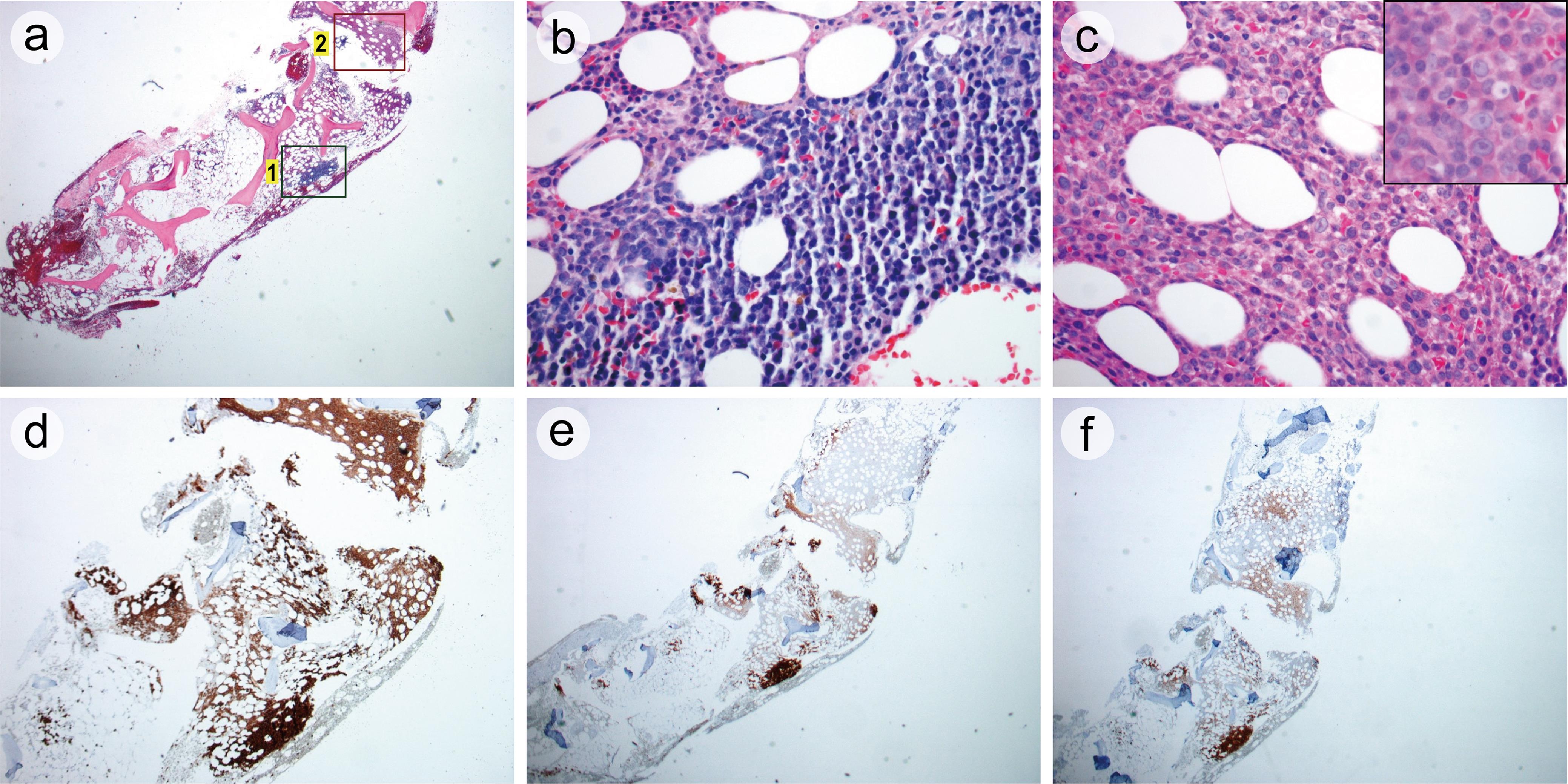 Bone marrow biopsy.