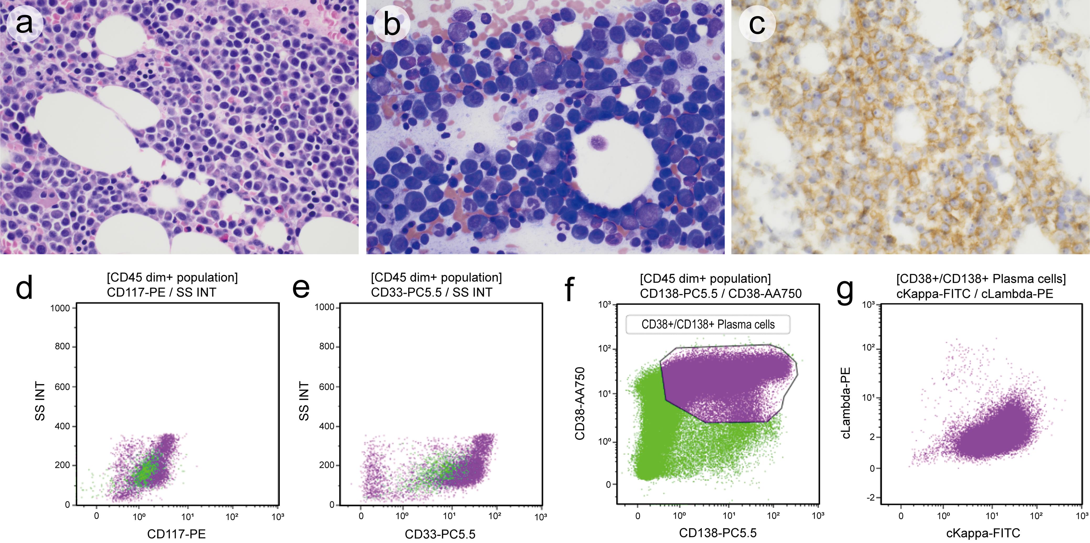 Bone marrow biopsy.