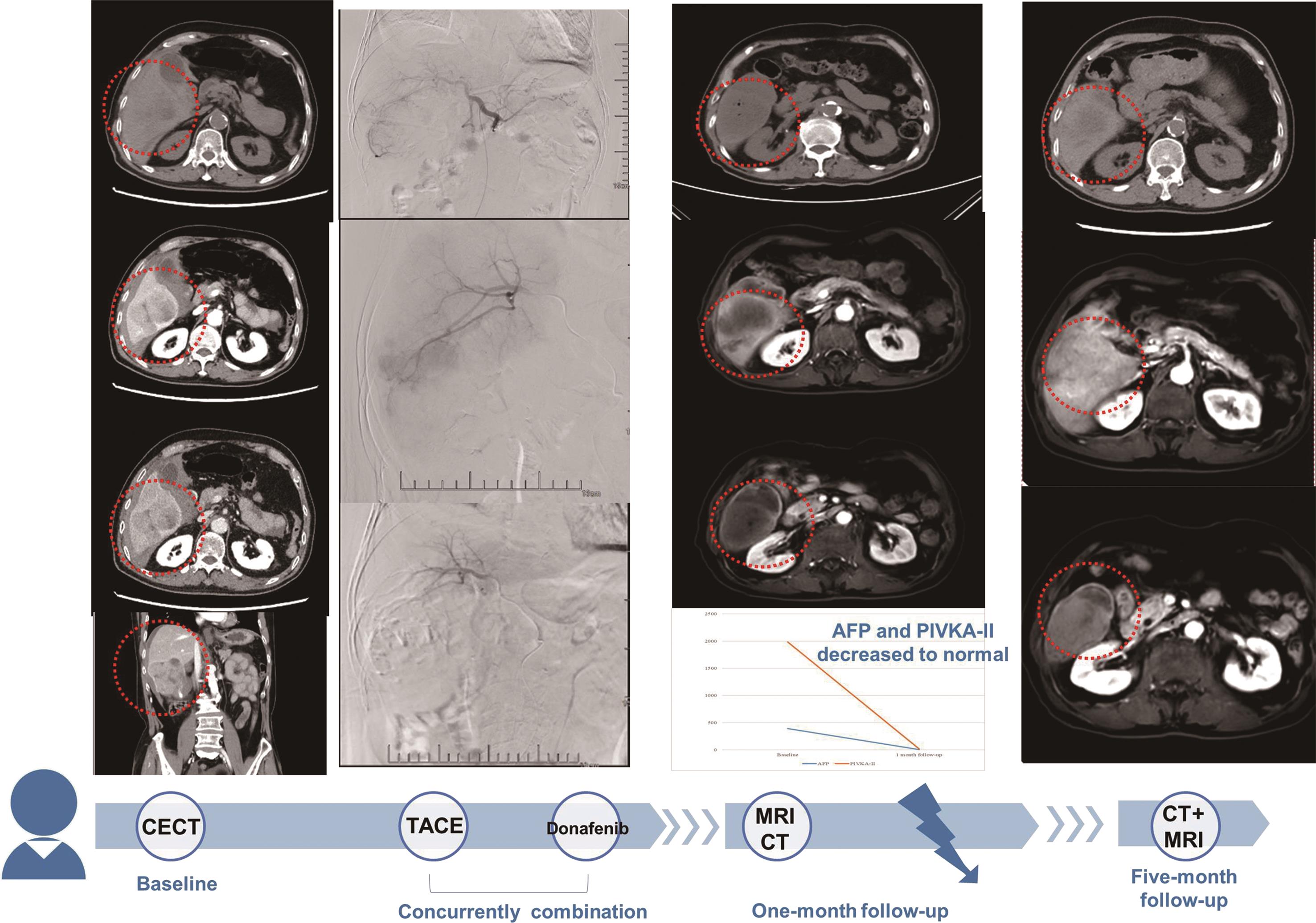 Images obtained in patients with HCC treated with TACE.