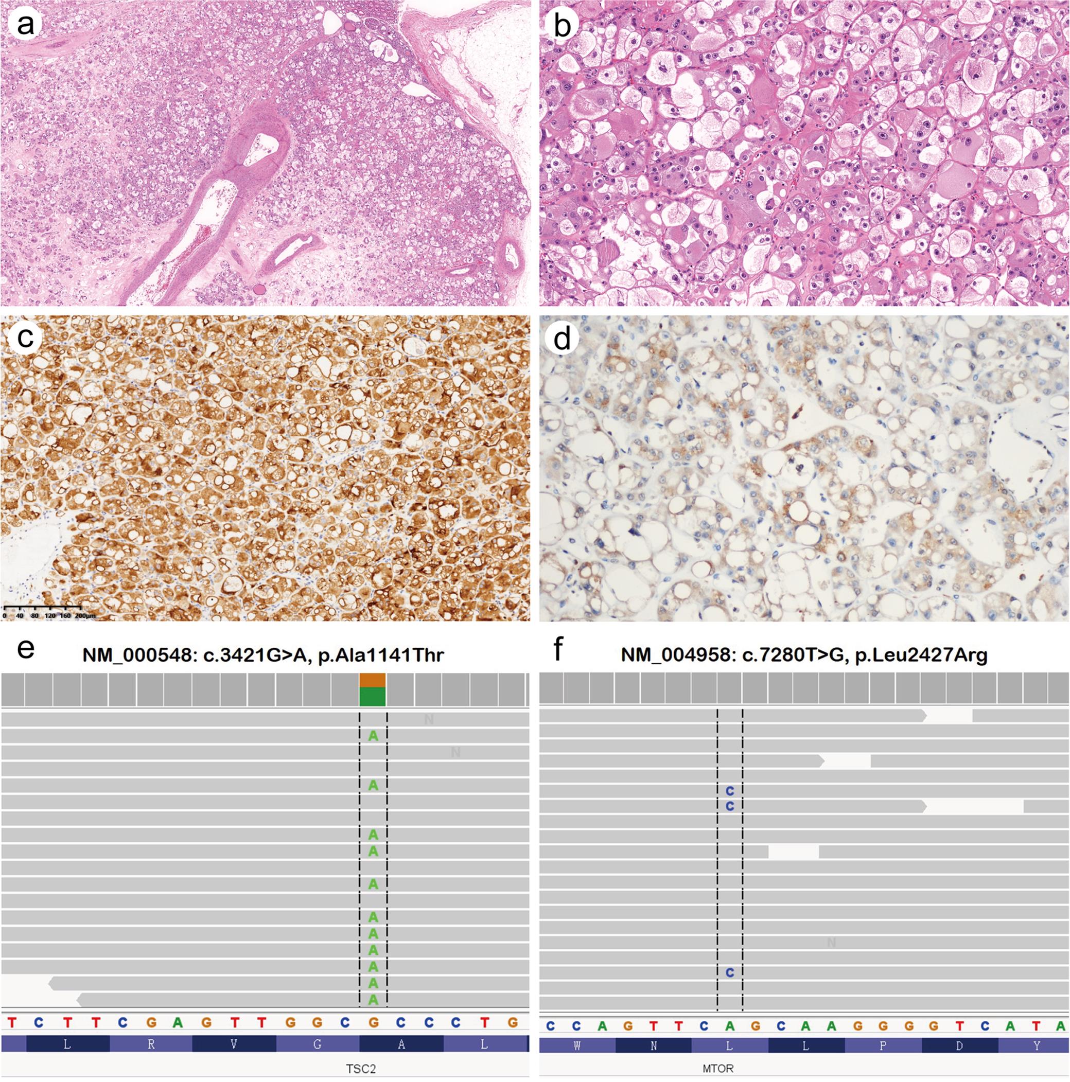 Eosinophilic vacuolated tumor (EVT).