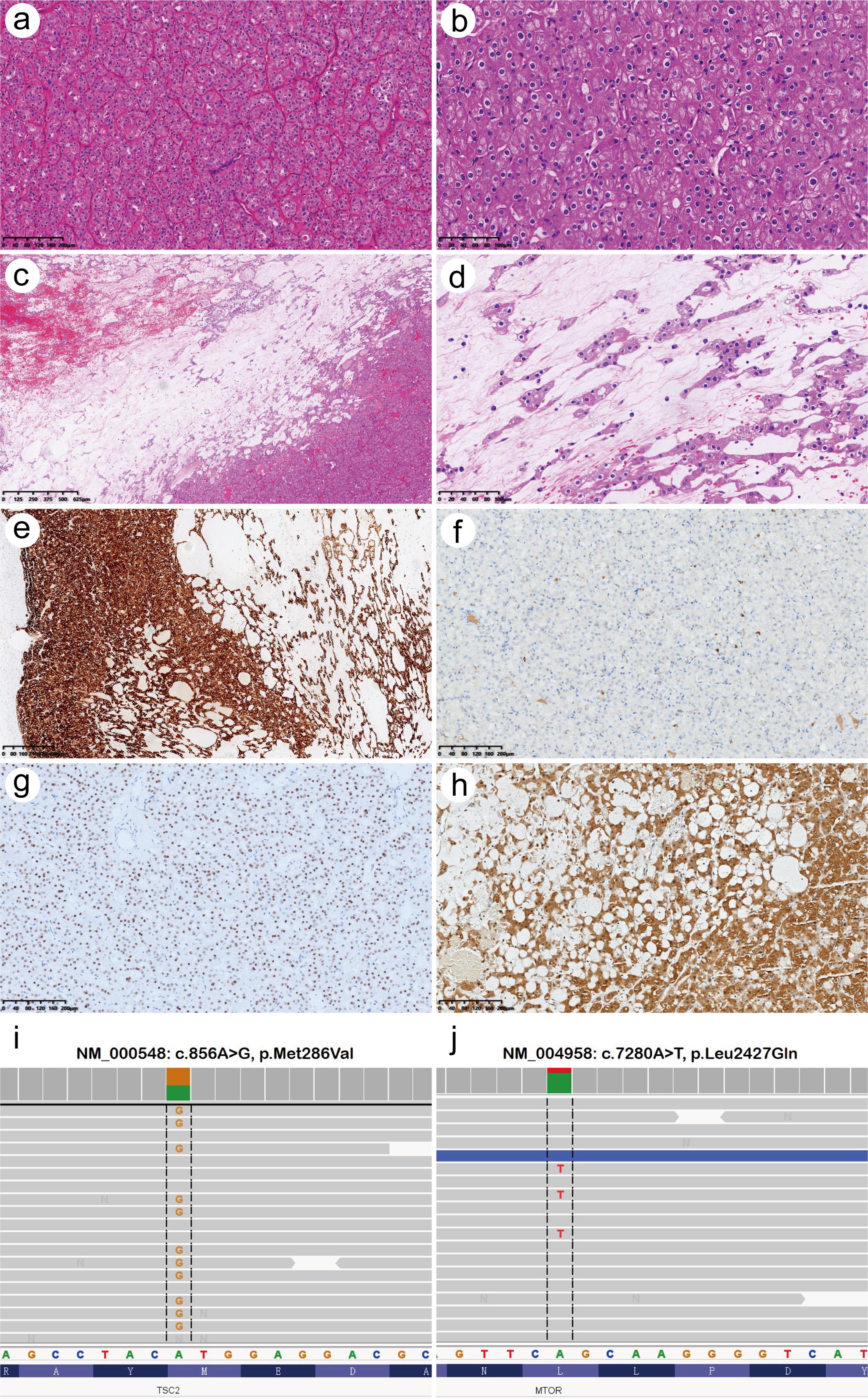 Low-grade oncocytic tumor (LOT).