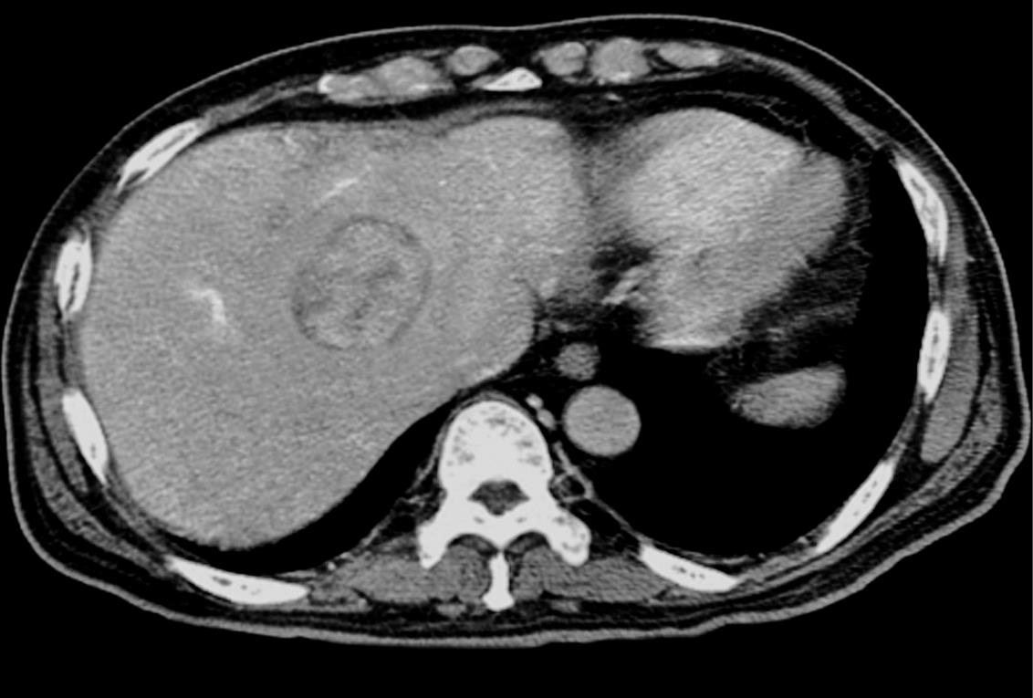 A contrast enhanced CT scan discloses relatively well unencapsulated IMT on the right lobe of the liver.