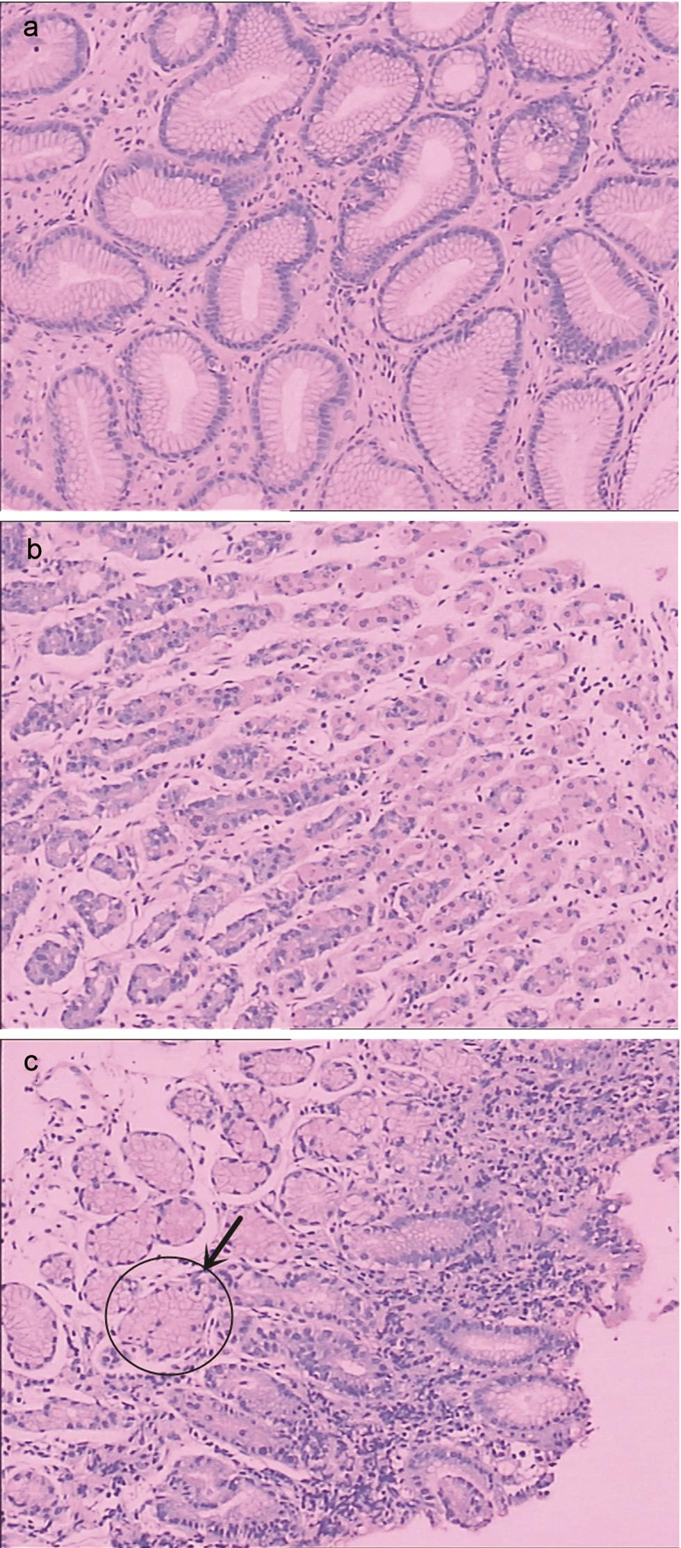 Gastric glands and antralization.