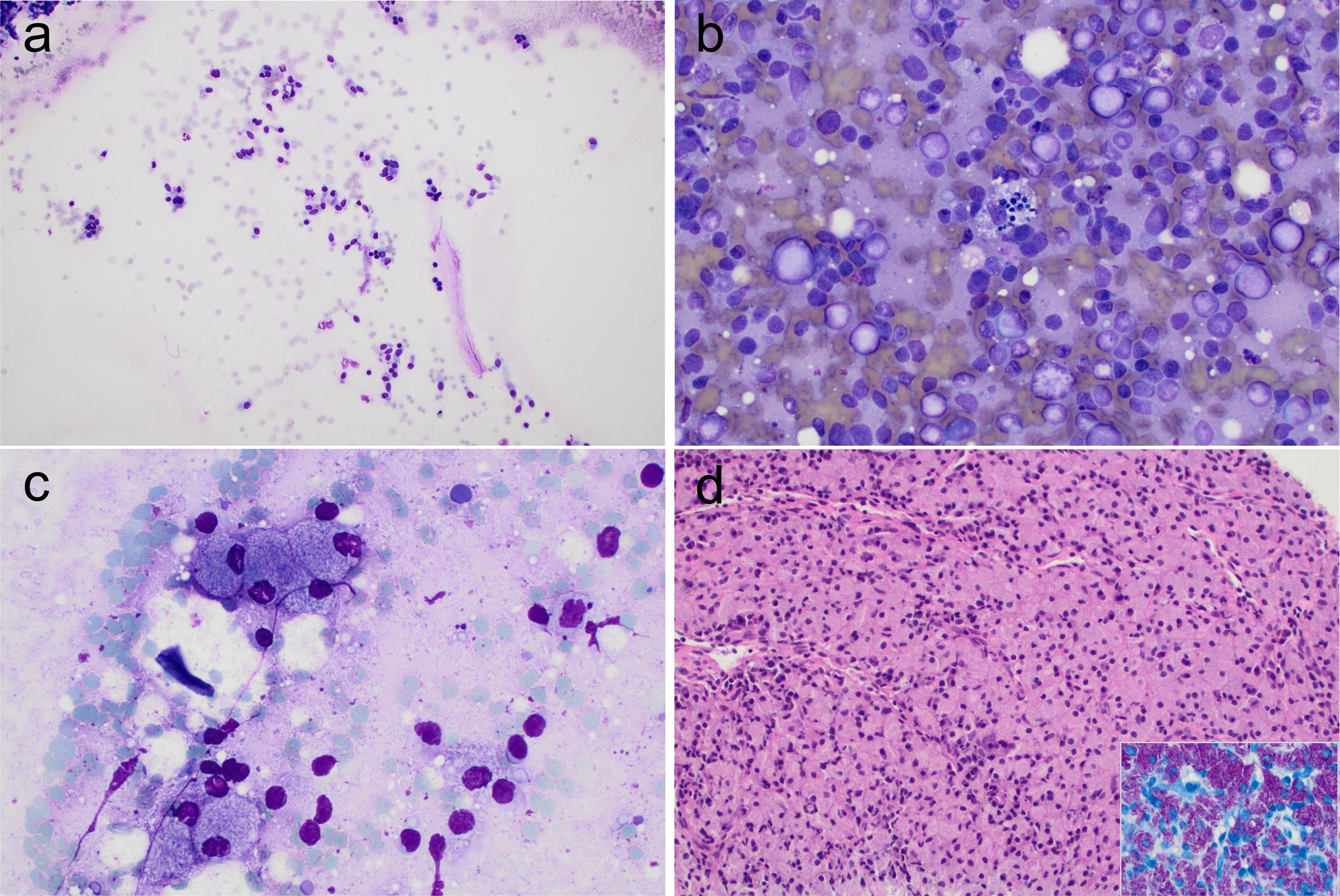 Non-diagnostic (a). The fine-needle aspiration of the subcarinal lymph node shows abundant bronchial epithelial cells only (DQ, 100×). Benign (b–d). b. Polymorphous lymphocytes and tingible body macrophages of a reactive axillary lymph node (DQ, 100×). c–d. Foamy histiocytes with abundant intra-/extracellular acid-fast bacilli and lymphocytes of a cervical lymph node with Mycobacterium avium complex infection (c. DQ, 400×; d. Needle core biopsy: H&E, 200×; insert, acid-fast stain, 500×).