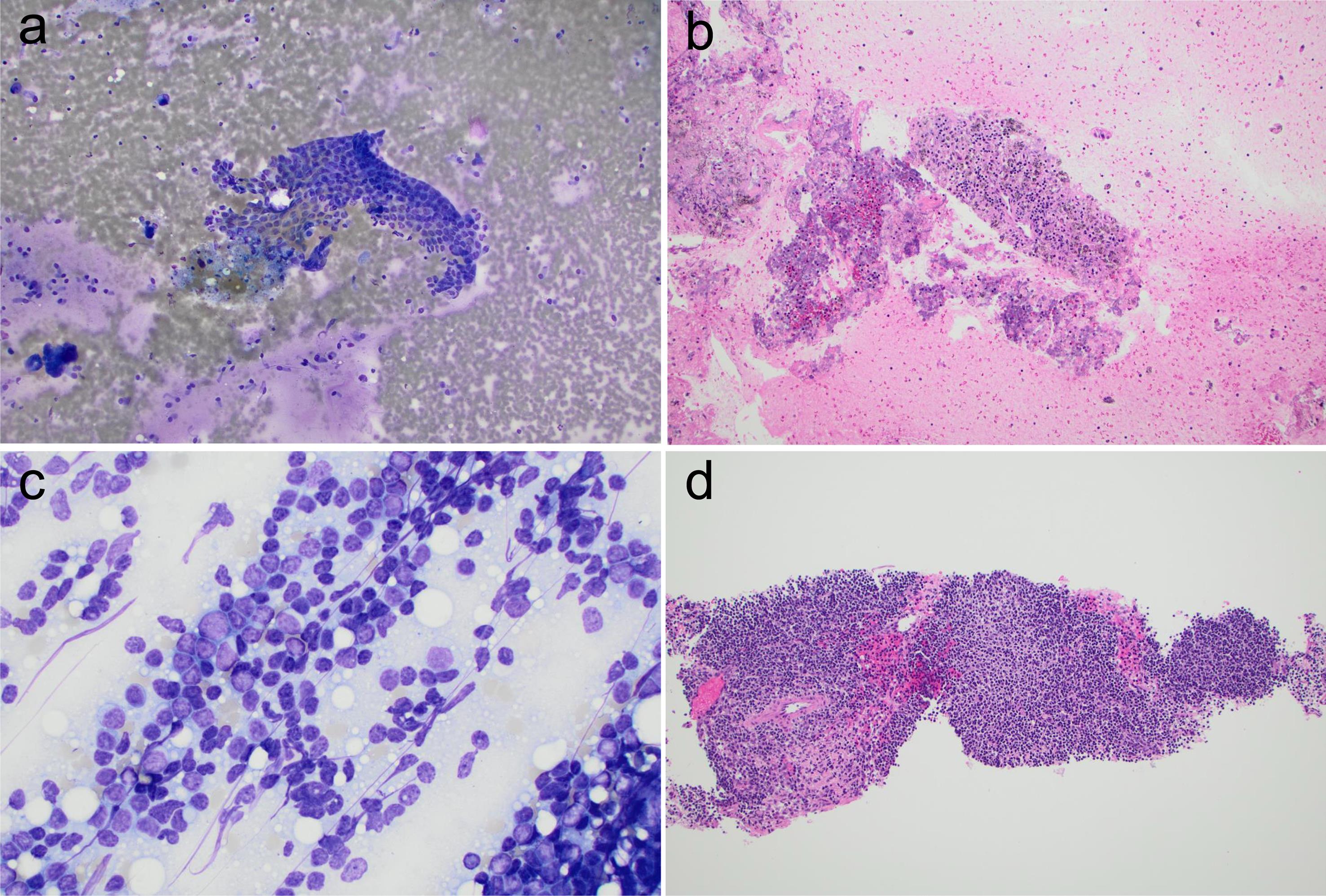 Atypical (a–b). Rare clusters of atypical cells and lymphocytes on smear slide but absent on the cell block slide from a pre-carinal lymph node (a. DQ, 200×; b. H&E 100×). Suspicious for malignancy (c–d).