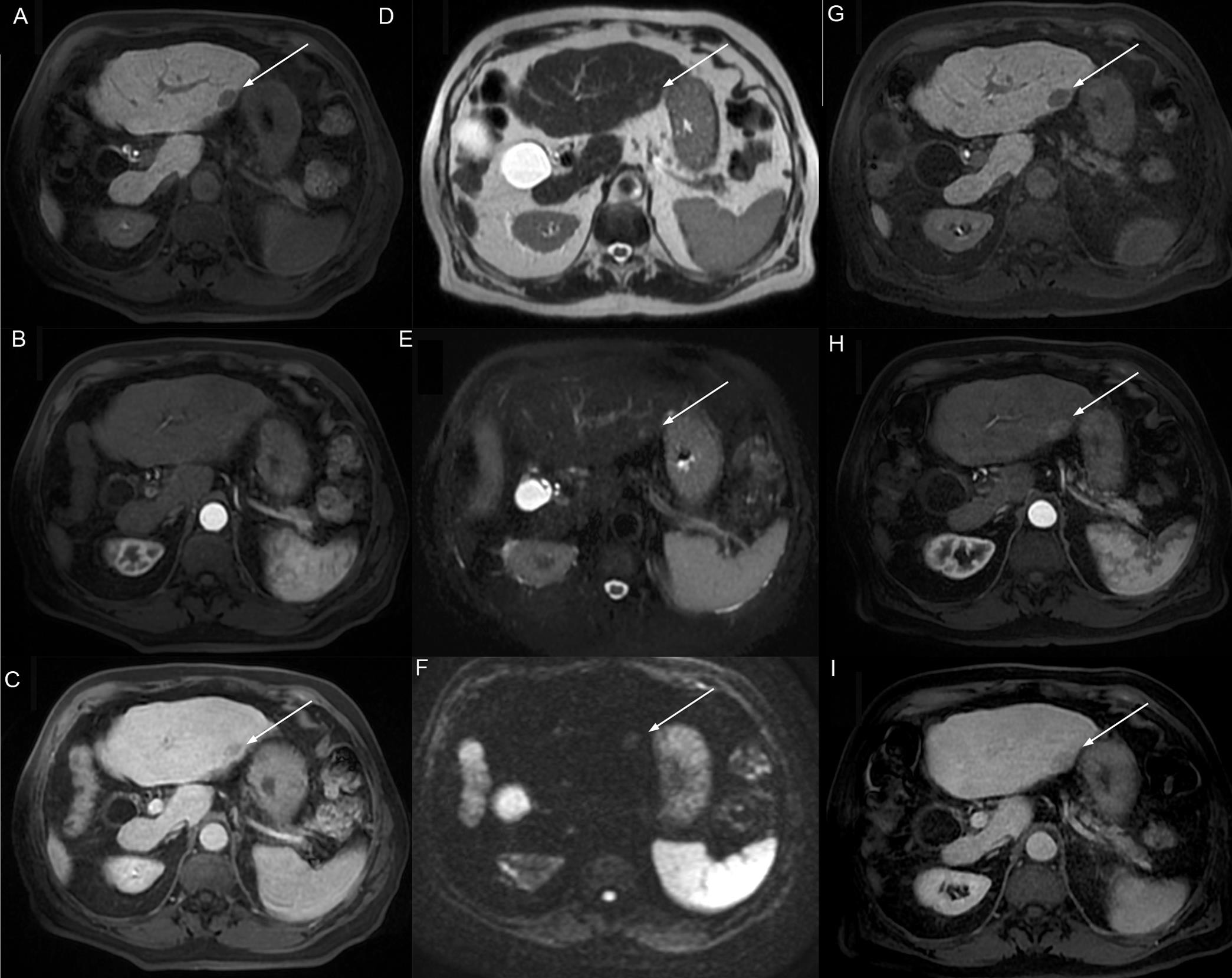Axial MR images demonstrate a 17 mm nodule in the liver segment 2.