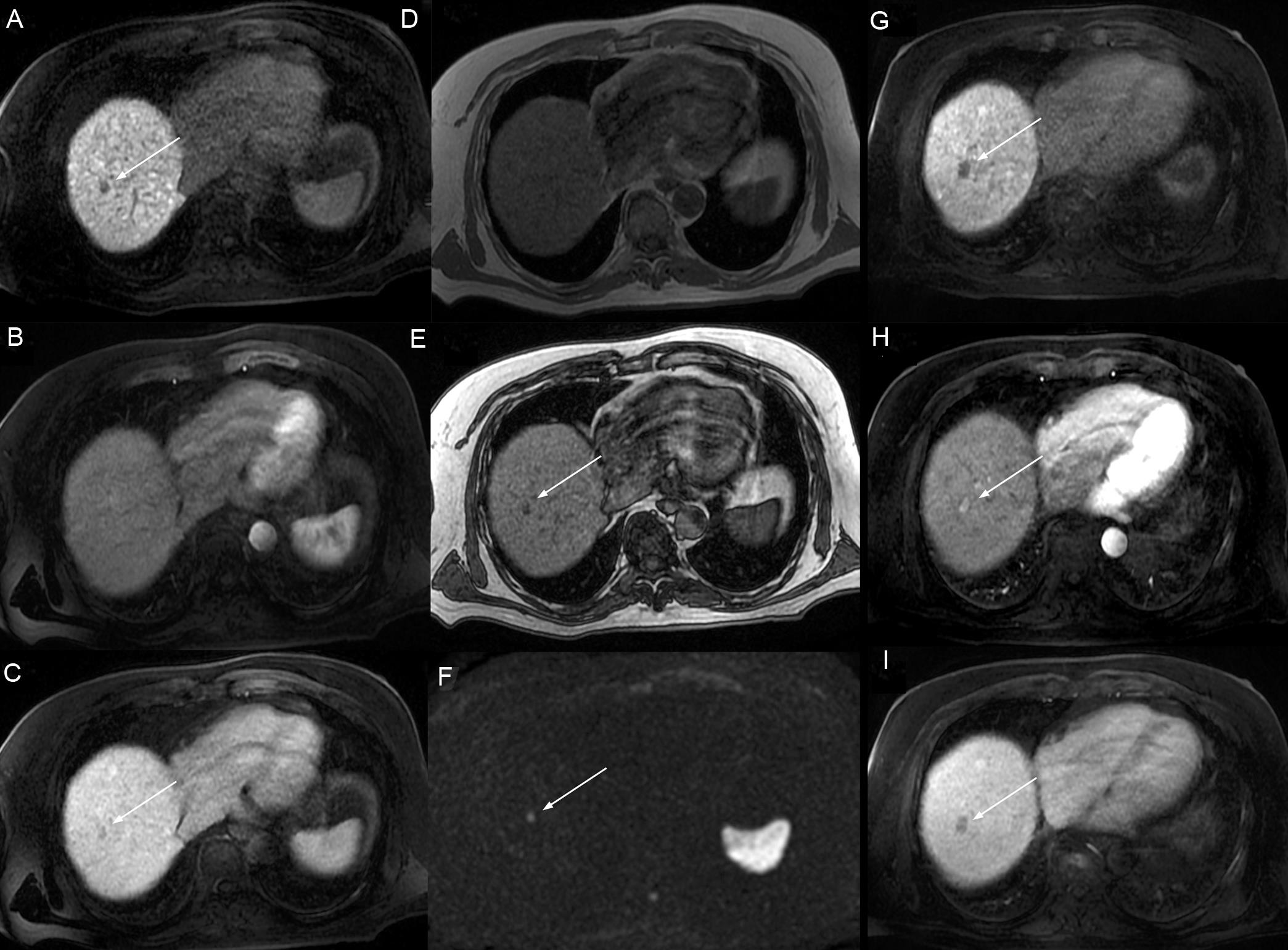 Axial MR images demonstrating a hypointense nodule of 11 mm in the hepatobiliary phase (HBP) located in the liver segment 8.