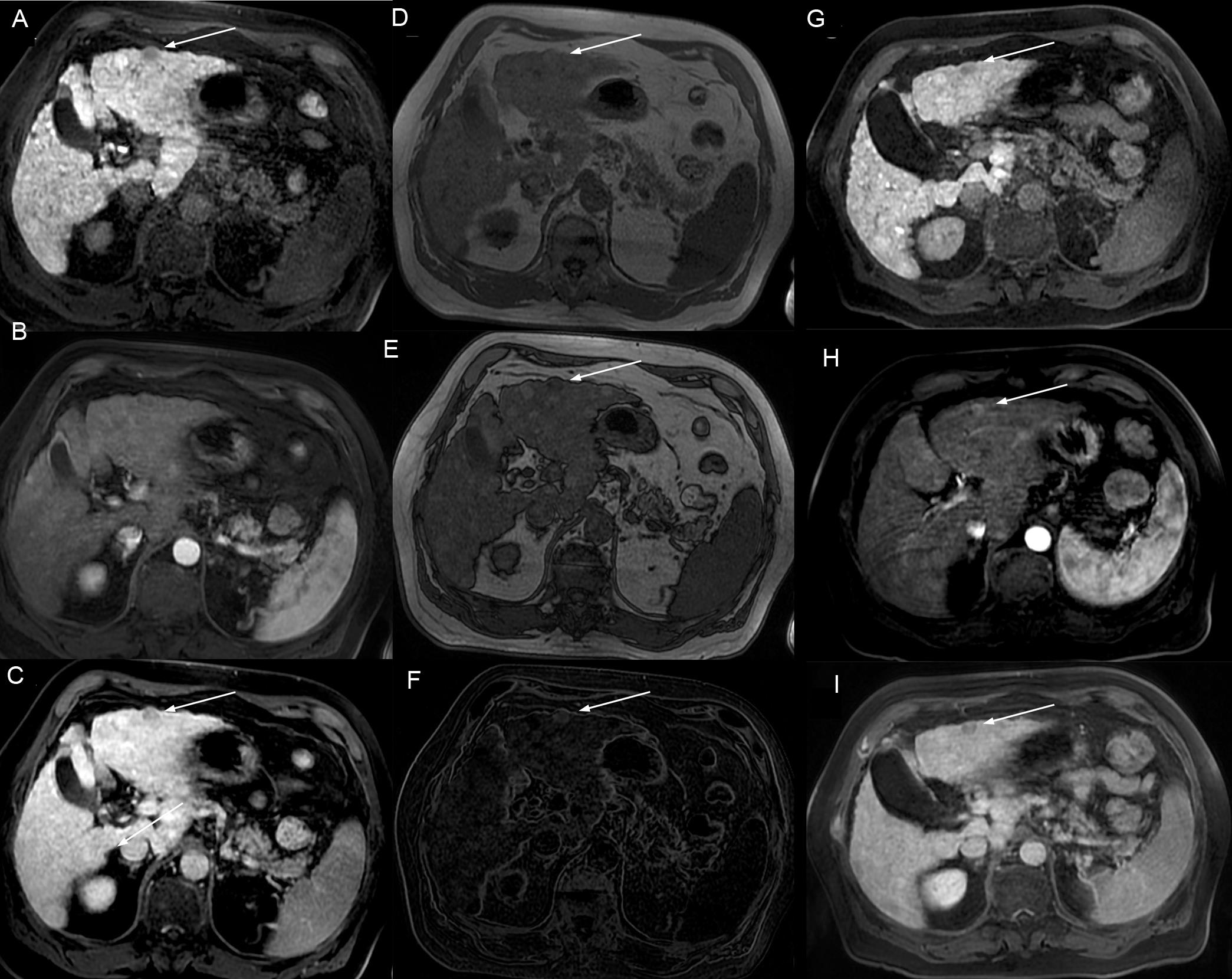 Axial MR images demonstrating a 14 mm hypointense nodule in the hepatobiliary phase (HBP) located in the liver segment 3.