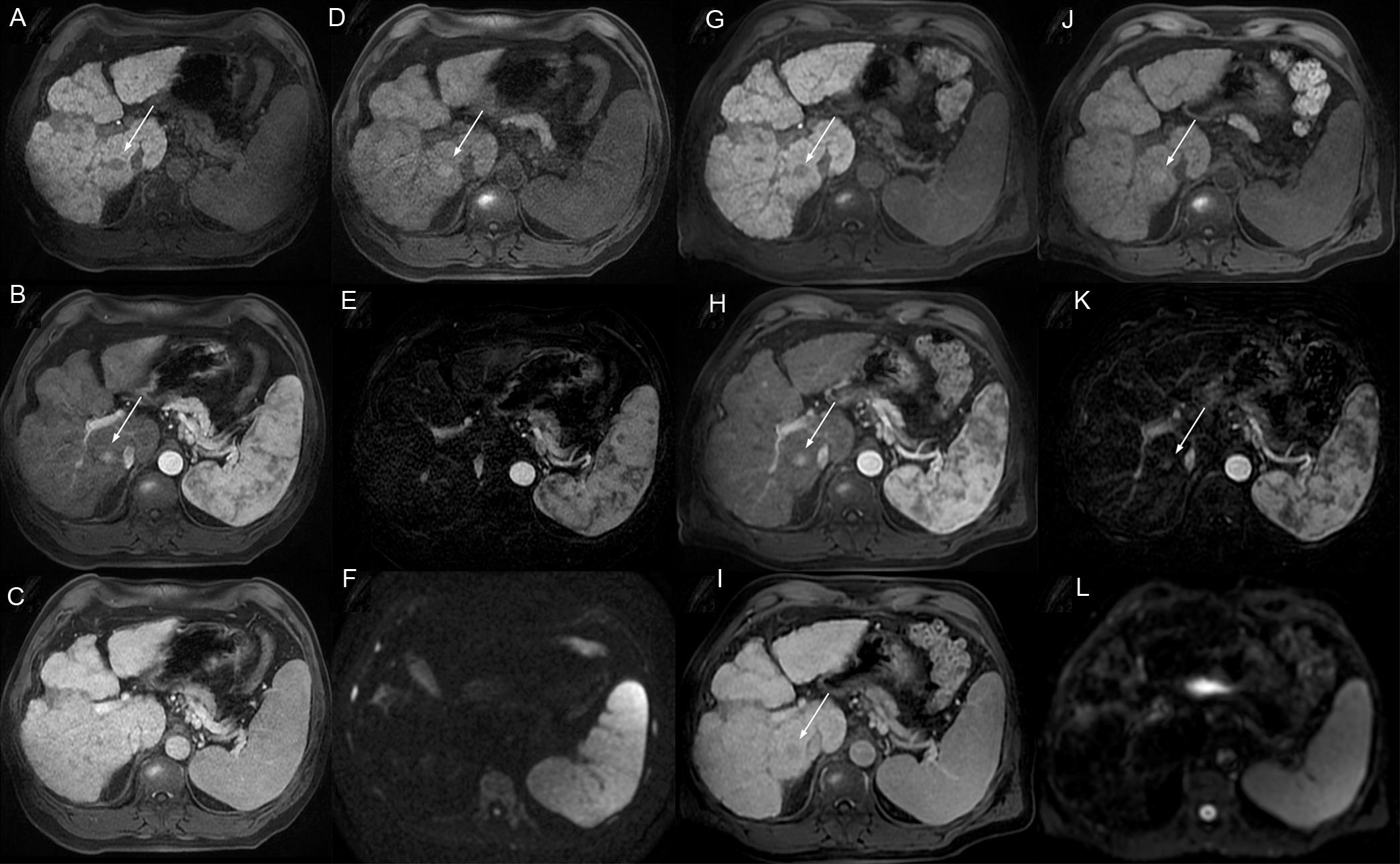 Axial MR images showing a 17 mm nodule in liver segment 6.