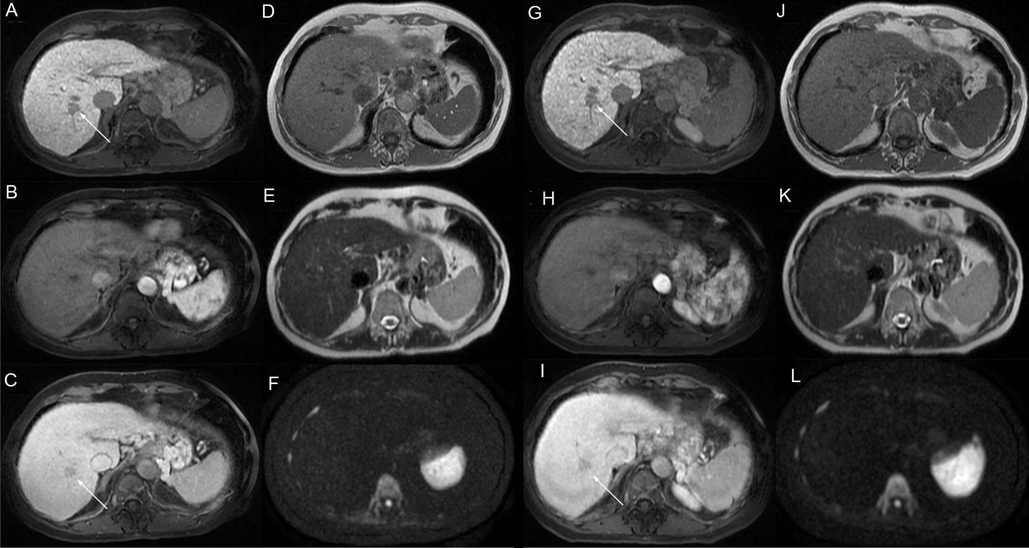 Axial MR images showing a hypointense 16 mm nodule in the hepatobiliary phase (HBP) located in liver segment 8.