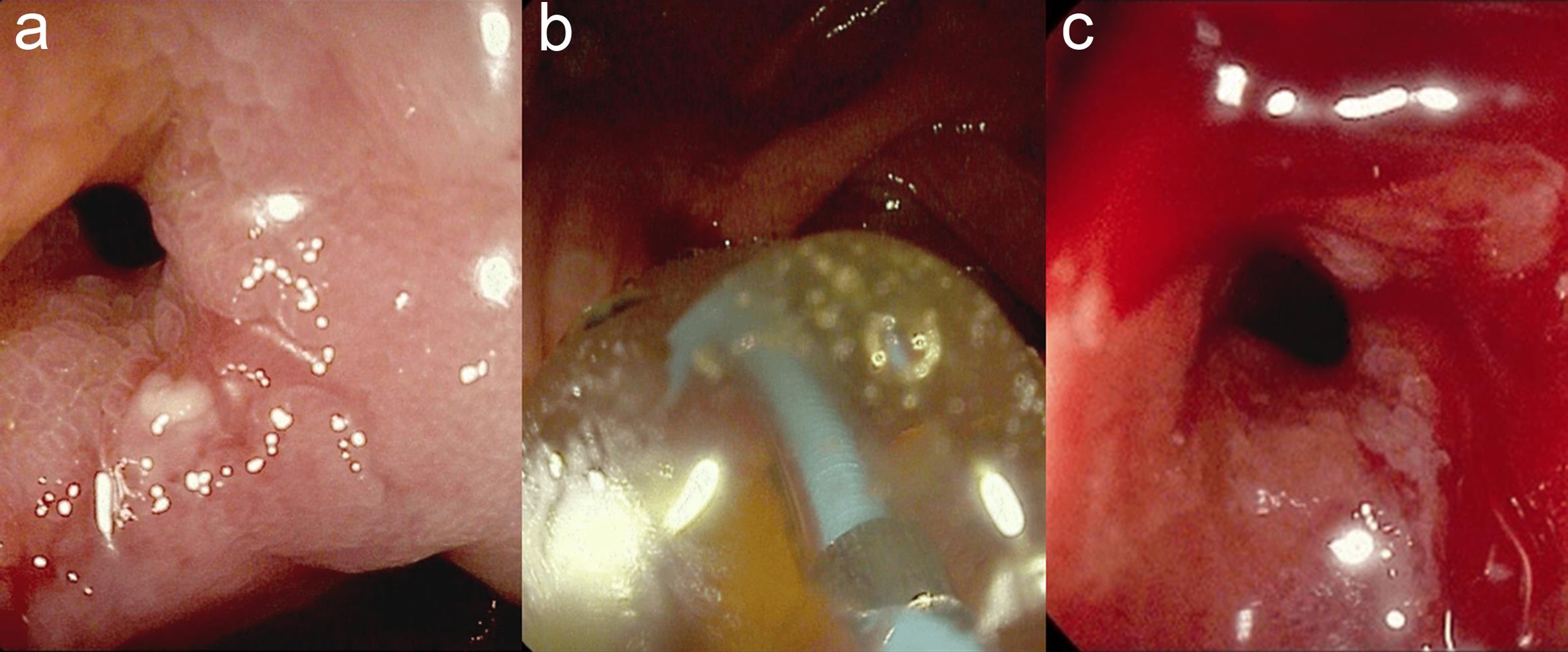 Non endoscopically transitable ileo-ciecal stenosis in CD treated with wire guided endoscopic balloon dilatation.