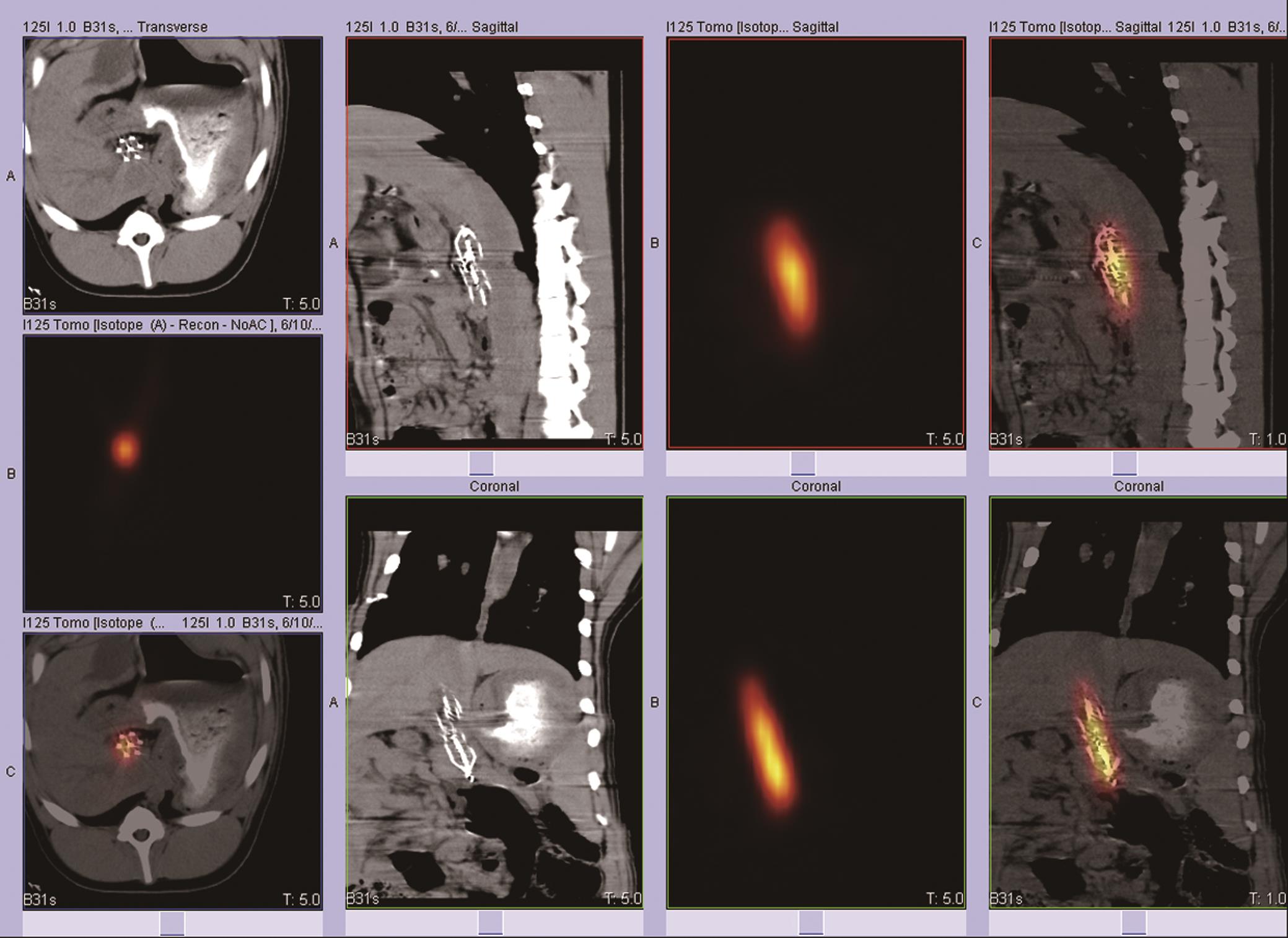 Images obtained by performing a SPECT/CT scan 1 day after the procedure was performed.