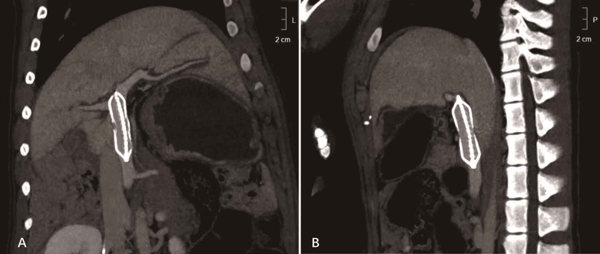 CT images obtained 2 months after the operation was performed.