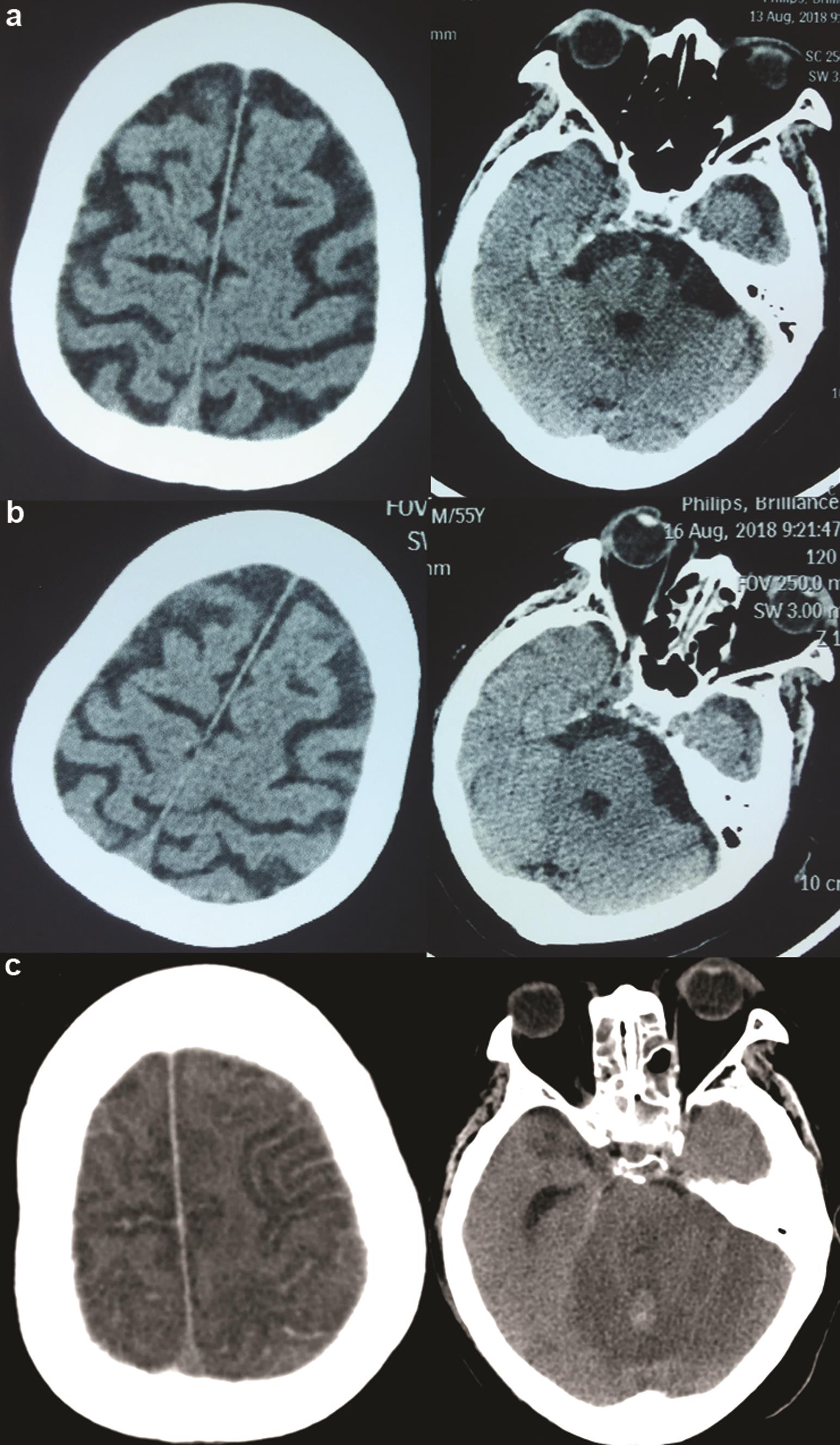 Exemplary images of matching slice plains in the non-enhanced CT scan.